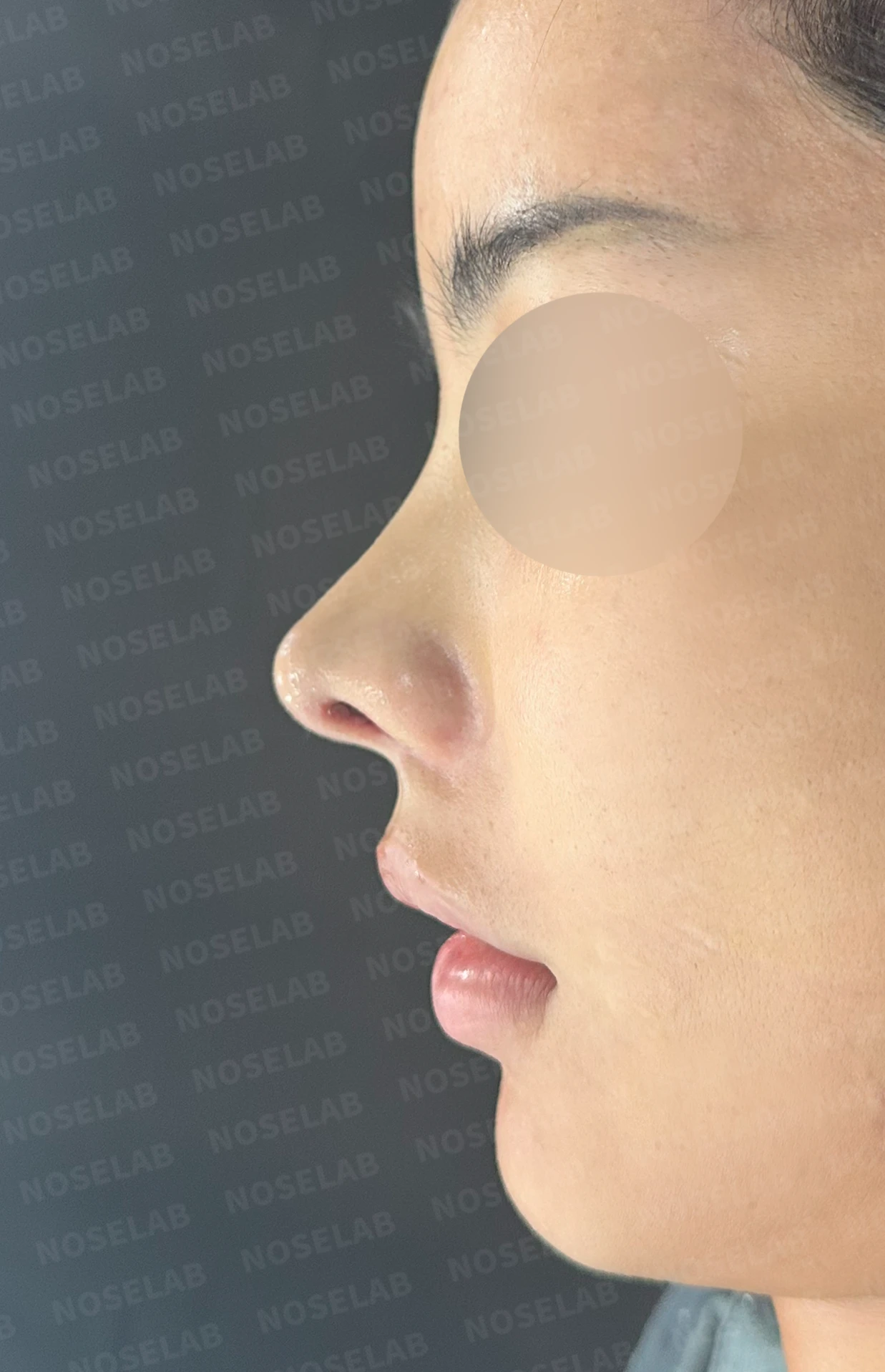 코성형 뒤 코끝이 처지고 웃을 때 퍼지는 이유, 이물질 제거와 코끝 교정 방법 — 수술 전 / 수술 직후 0일 직후 사진은 부기가 있는 상태로 최종 결과와 다를 수 있습니다.