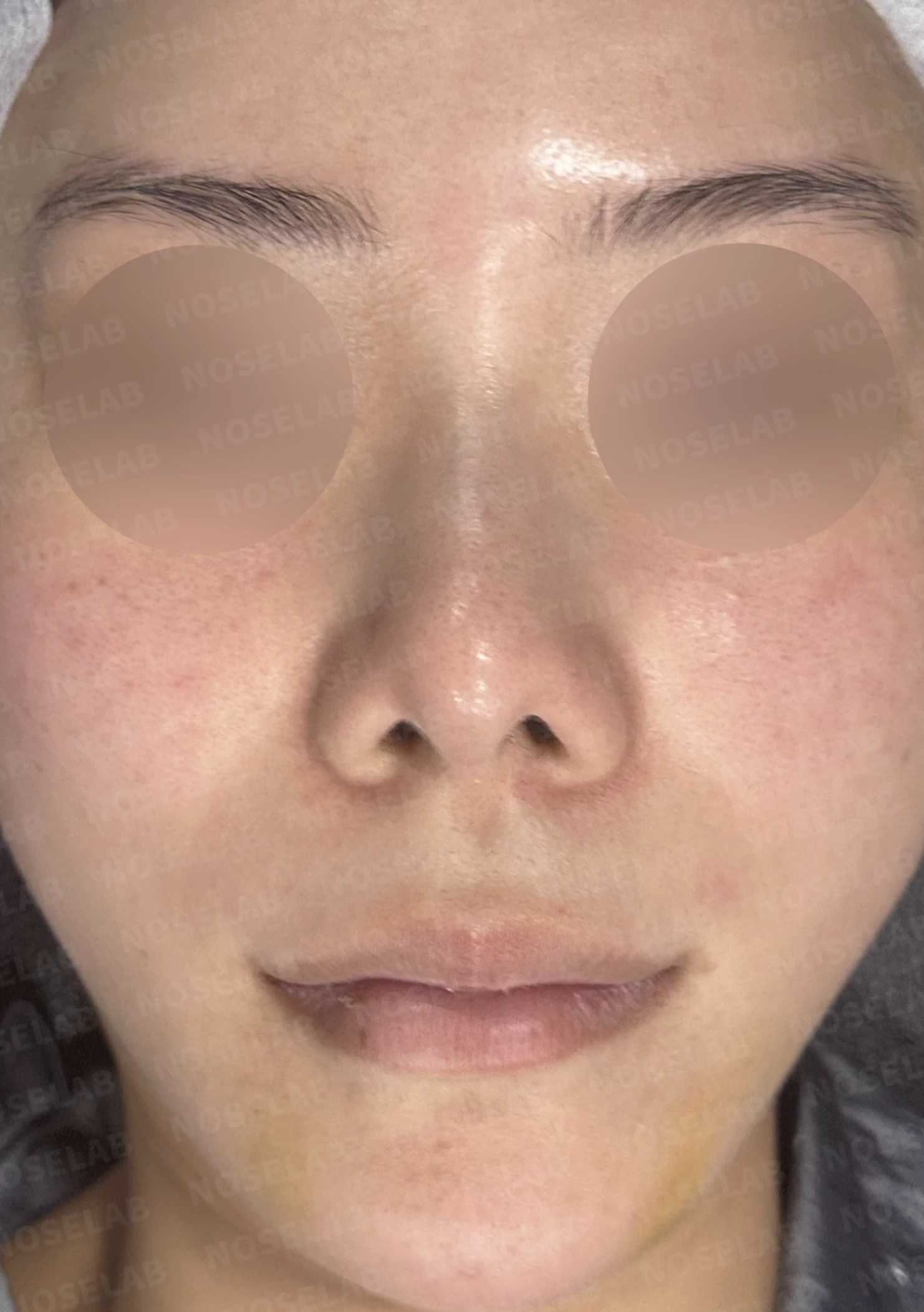 들린 코와 한쪽만 찝힌 콧구멍이 생기는 이유, 무보형물 재건은 어떻게 하나 — 수술 전 / 수술 직후 0일 직후 사진은 부기가 있는 상태로 최종 결과와 다를 수 있습니다.