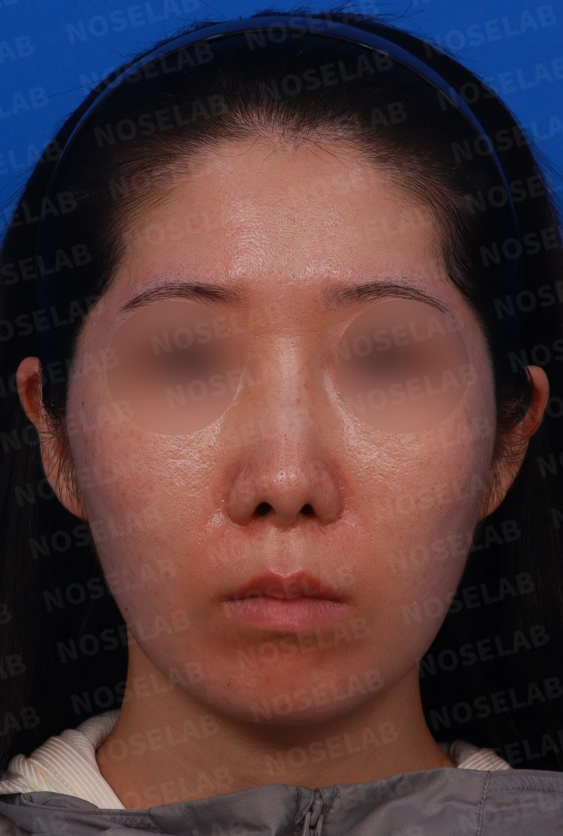 콧대 시작점이 높고 코가 휘어 보이는 이유, 자가 늑연골 교정은 어떻게 하나 — 디자인 상담 정면 , 비스듬한 측면 , 측면 사진입니다