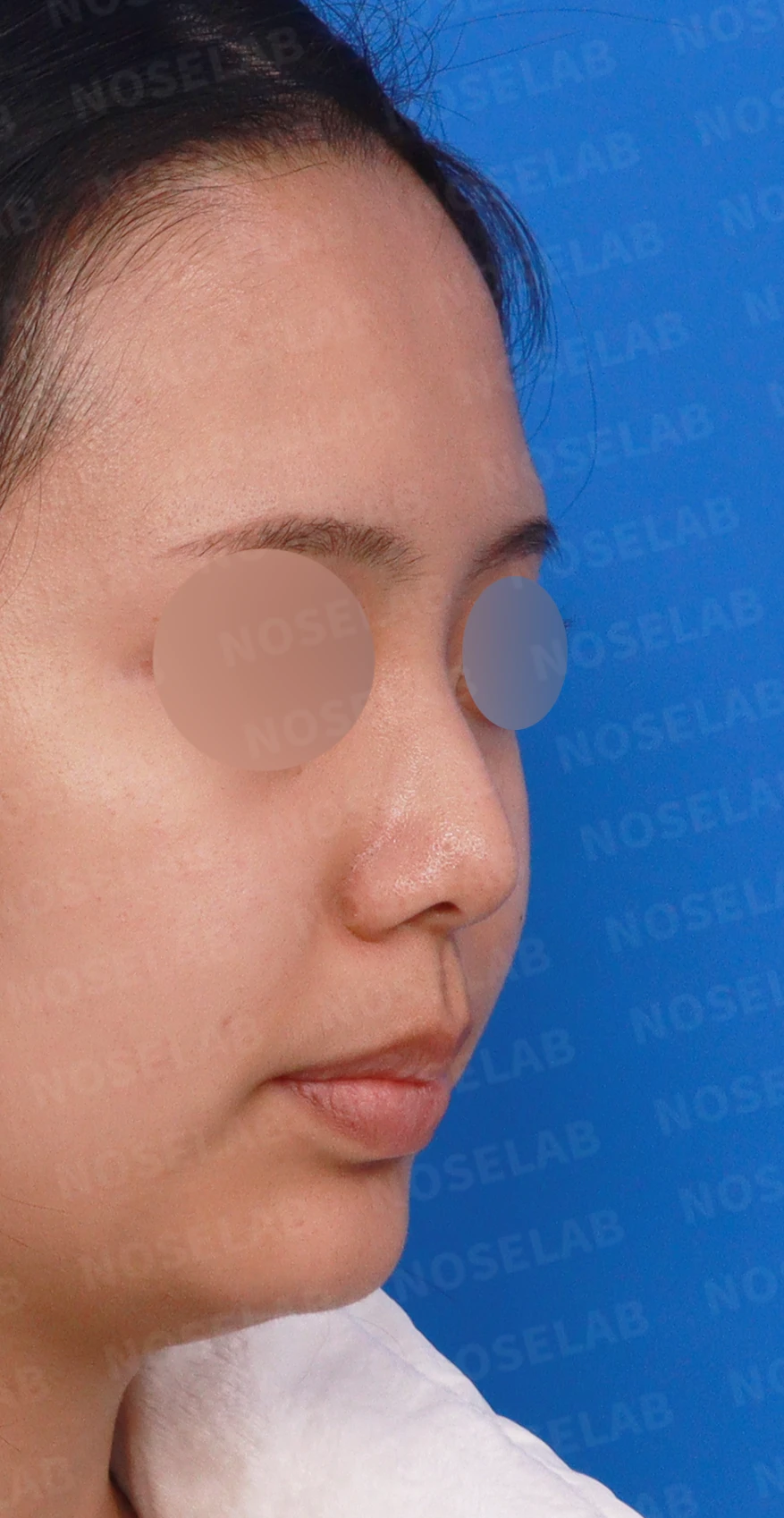 휘어진 매부리와 처진 코끝이 생기는 이유, 비중격 연장술은 어떻게 하나 — 디자인 상담 우측 측면, 비스듬한 측면, 비공 사진입니다.