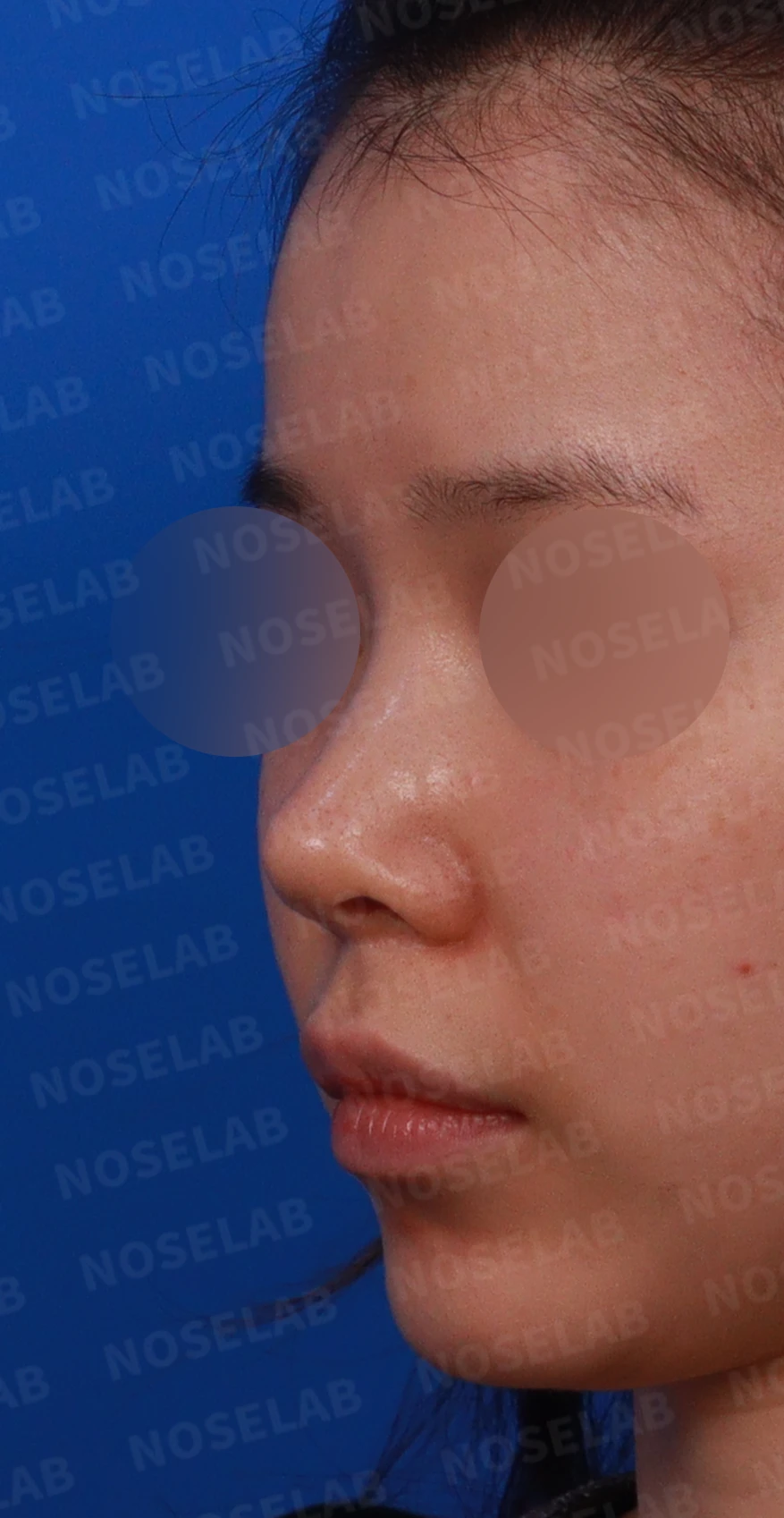 귀연골만으로 코끝을 받쳤을 때 생기는 변화와 늑연골 재건 방법 — 디자인 상담 정면, 비스듬한 측면, 좌측 측면 사진입니다.