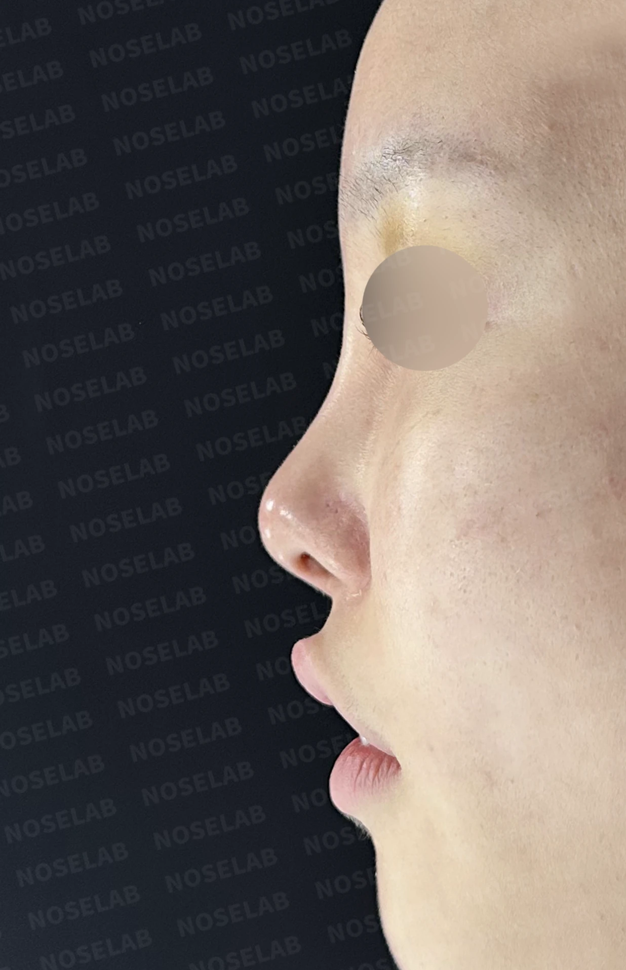 심한 비중격 만곡과 높은 콧대 시작점, 기증늑연골로 정밀 재건 — 전(좌) 직후(후)