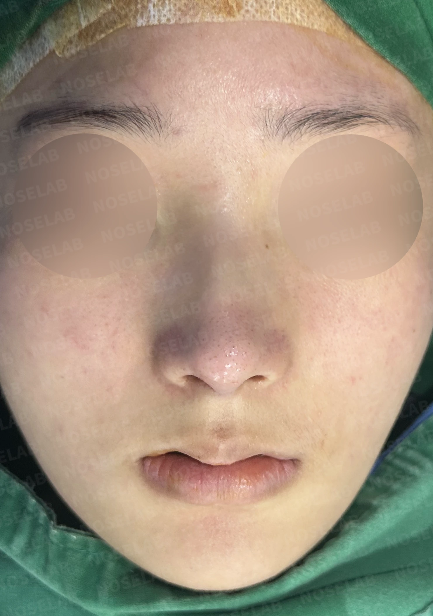 작은 콧날개 연골과 처진 코끝, 자가늑연골과 외측절골술로 자연스럽게 교정 — 수술직후 정면, 비스듬한 측면, 측면 사진입니다.