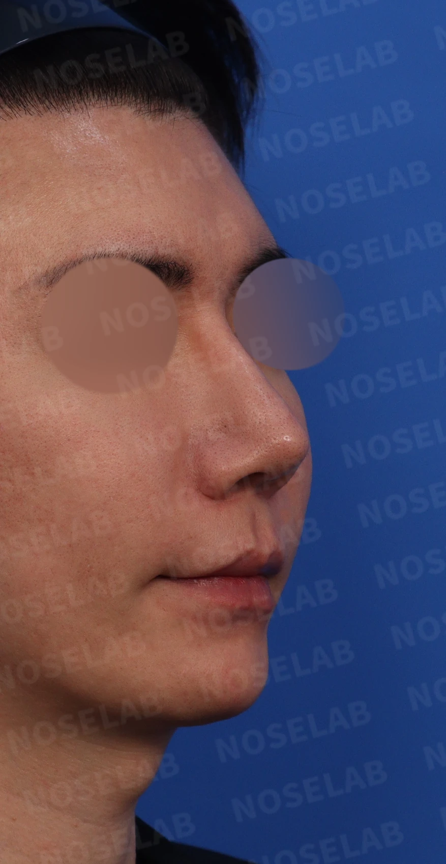 수술한 티가 나는 실리콘 보형물 교체 맞춤 코성형 방법 — 디자인 상담 정면, 측면, 비스듬한 측면