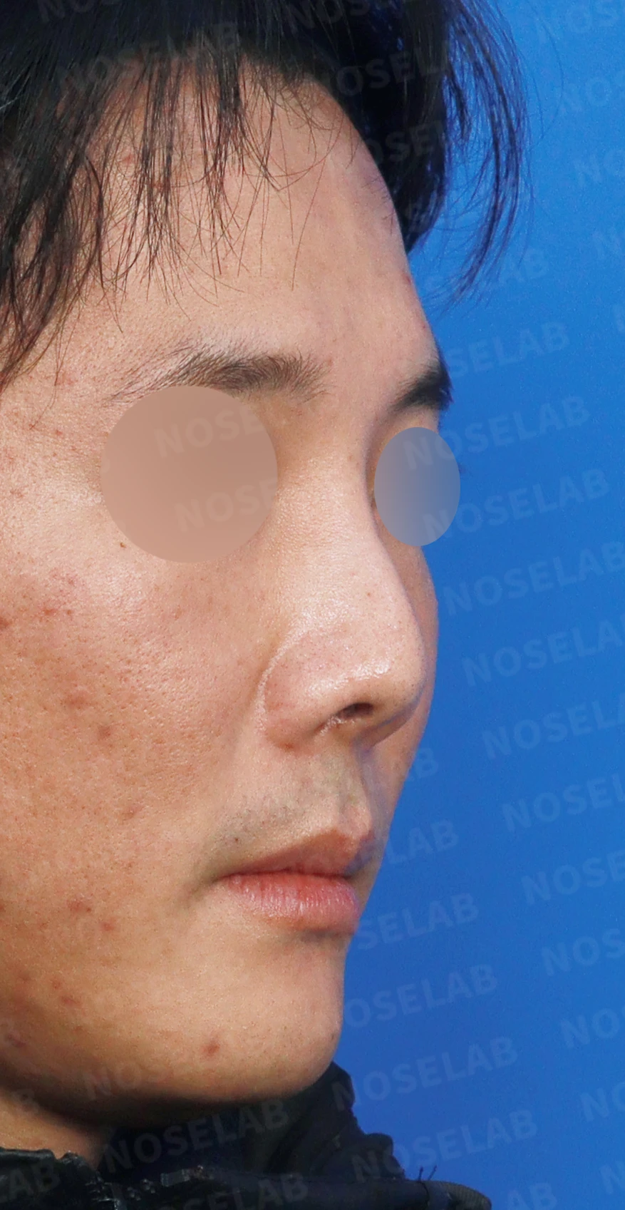 구축이 진행된 코, 조직 제거와 자가 늑연골 재건은 어떻게 하나 — 디자인 상담 우측 측면, 비스듬한 측면, 비공 사진입니다.