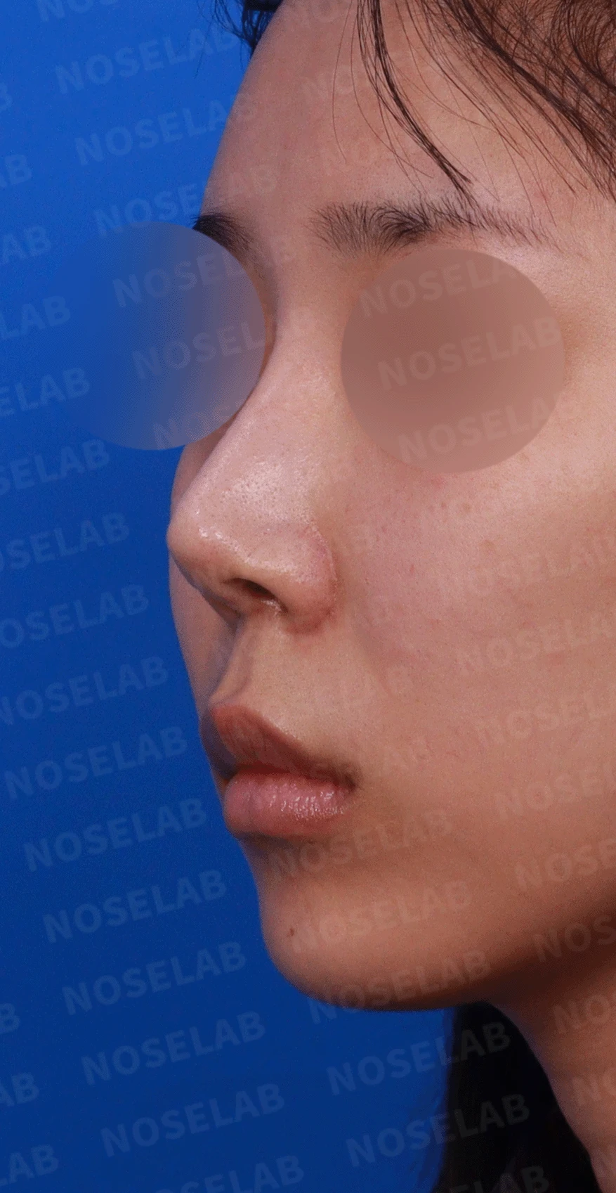 여러 번 수술한 코에 연골이 비치는 이유와 점막·구조 복원 방법 — 디자인 상담 정면 , 좌측 비스듬한 측면 , 측면 사진입니다.