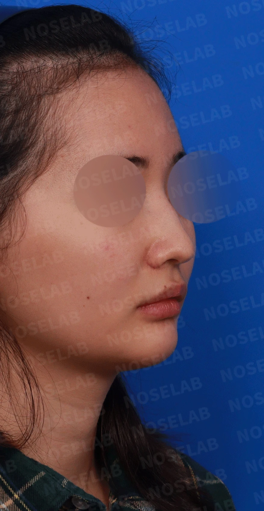 웃을 때만 화살코가 되는 이유와 코끝 연골 교정 방법 — 디자인 상담 우측 비스듬한 측면, 측면, 비공 사진입니다.
