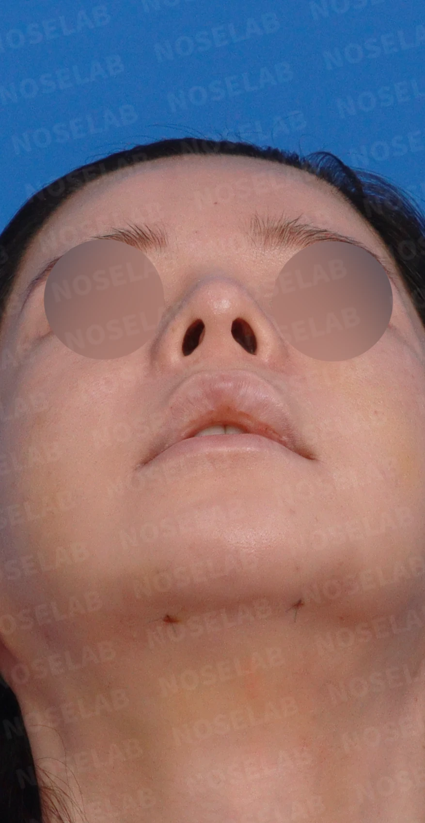 양악 수술 뒤 코가 퍼지고 낮아지는 이유와 비중격 재건 — 디자인 상담 우측 측면, 비스듬한 측면, 비공 사진입니다.