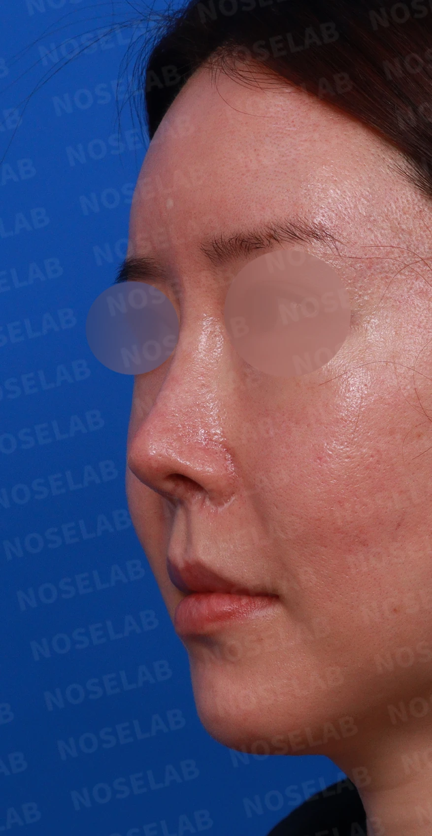 반복 수술 후 들창코와 반버선코를 교정하는 방법 — 수술전 디자인 상담 정면, 우측 측면, 비스듬한 측면 사진입니다.