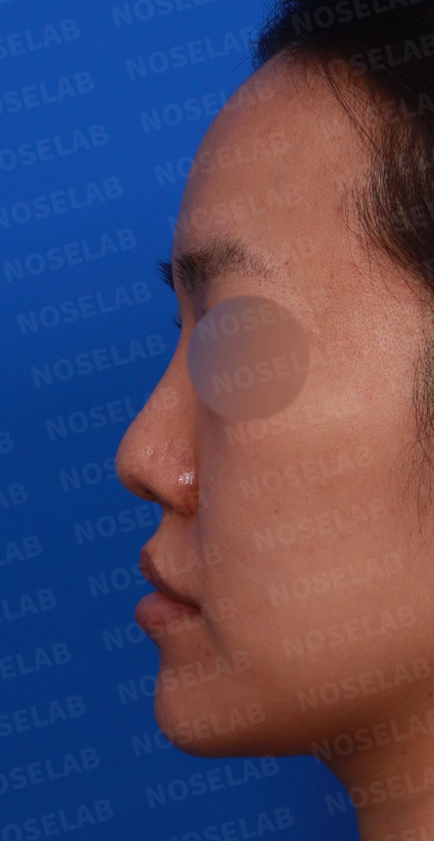 구순구개열에 동반된 코 변형의 교정 방법 — 디자인 상담 사진입니다. 정면, 좌측 비스듬한 측면, 측면