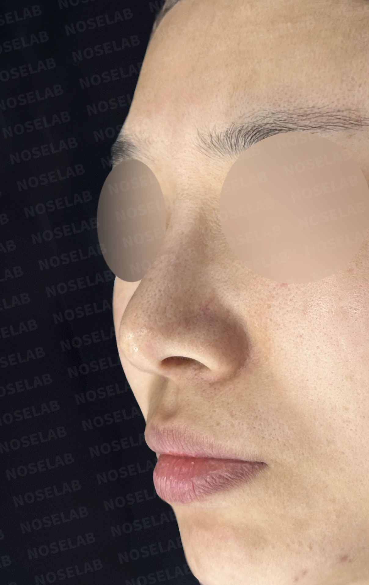 비공 비대칭과 휘어진 코, 자가늑연골 재건으로 교정한 코재수술 — 전(좌) 직후(후)
