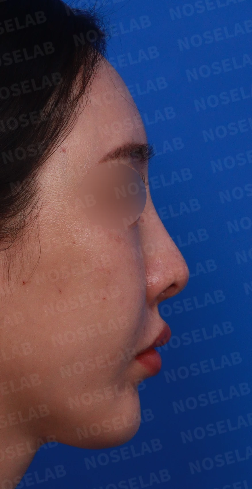 코성형 후 염증이 반복되는 이유와 자가 조직만으로 재건하는 방법 — 디자인 상담 우측 비스듬한 측면 , 측면 , 비공 사진입니다.