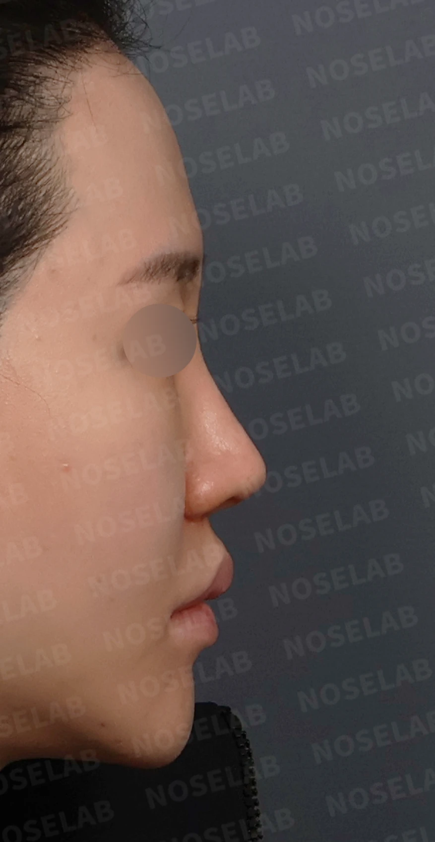 콧구멍 좌우가 심하게 달라 보이는 이유, 연골 재건과 피부이식 교정은 어떻게 하나 — 디자인 상담 우측 측면, 비스듬한 측면, 비공 사진입니다.