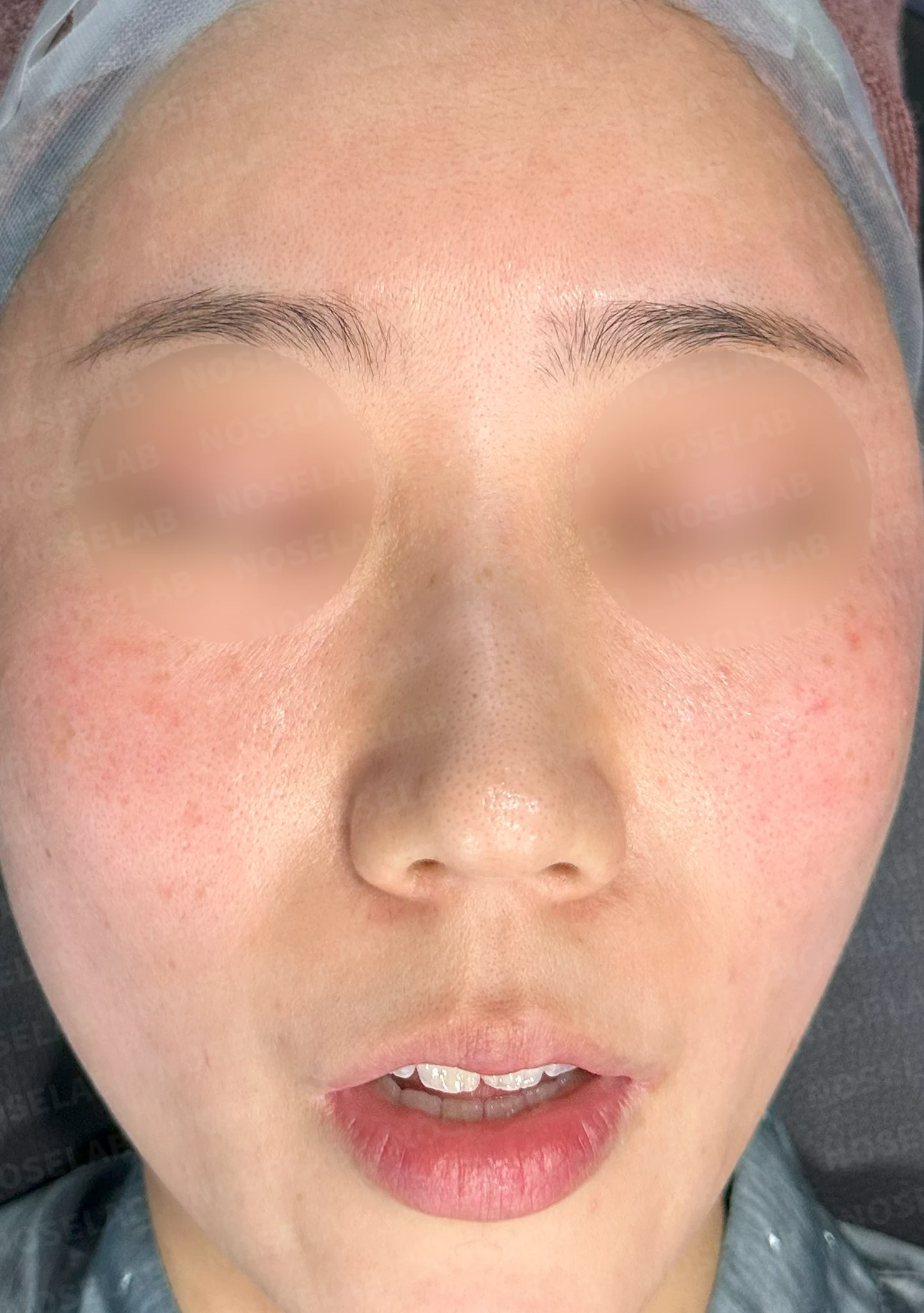 코뼈 비대칭과 처진 코끝에 만성 비염이 겹칠 때 보는 것 — 수술 전 / 수술 직후 0일 직후 사진은 부기가 있는 상태로 최종 결과와 다를 수 있습니다.