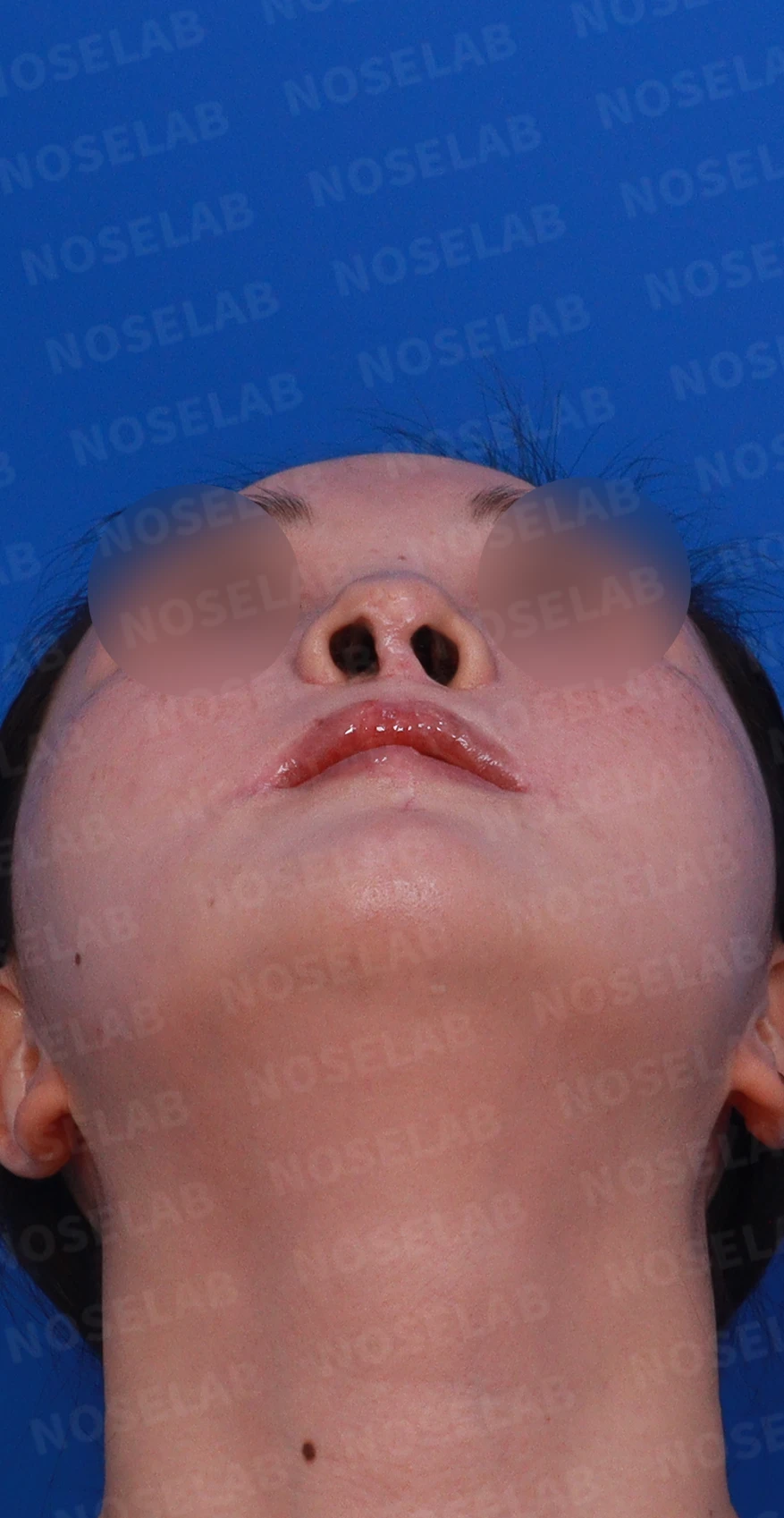 구순구개열에서 코 비대칭이 남는 이유와 늑연골·귀연골 재건 방법 — 디자인 상담 우측 측면 , 비스듬한 측면 , 비공 사진입니다.