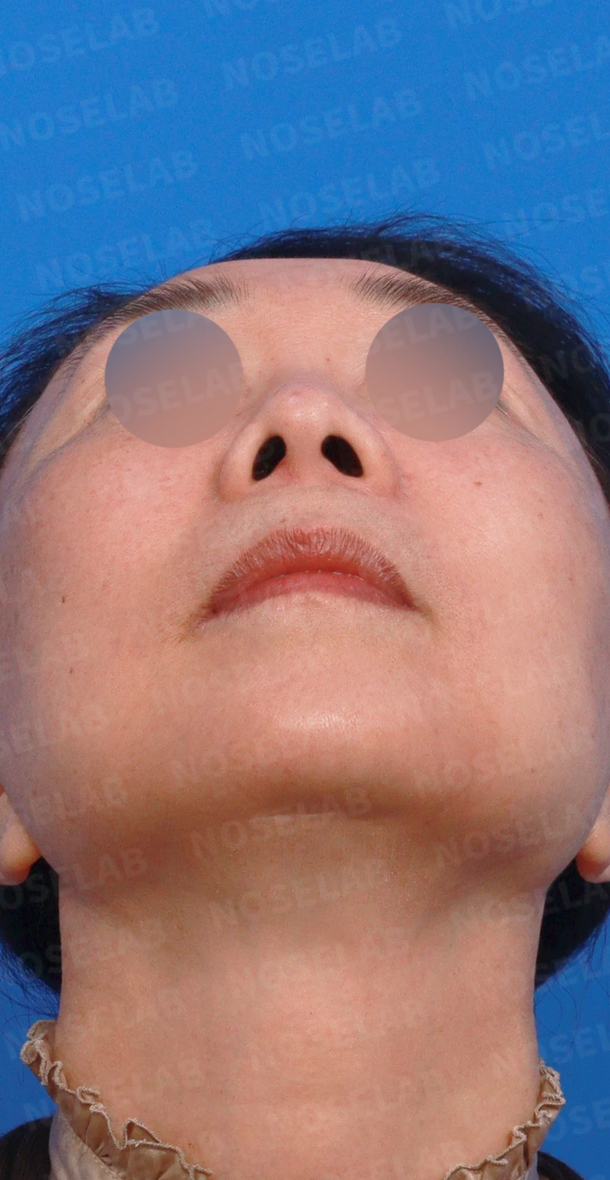 정면에서 콧구멍이 한쪽만 더 보이는 이유와 코끝 재건 방법 — 디자인 상담 우측 측면, 비스듬한 측면, 비공 사진입니다.