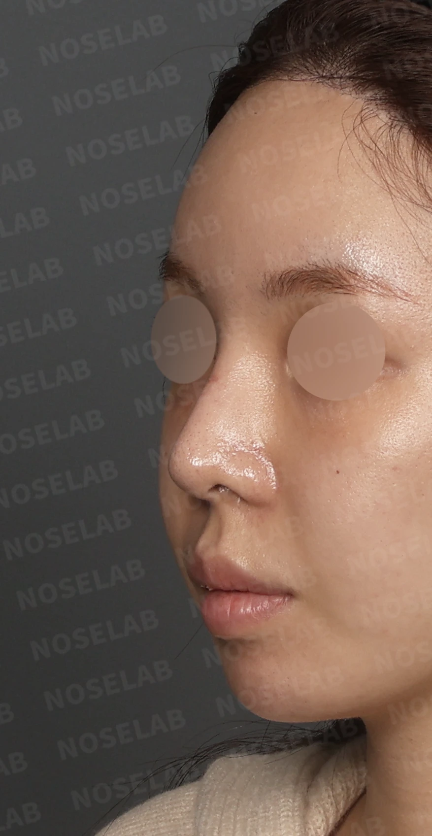 처지고 휘어진 코, 자가늑연골로 비중격 재건하고 코막힘까지 해결한 코재수술 사례 — 디자인 상담 정면, 좌측 측면, 비스듬한 측면 사진입니다.