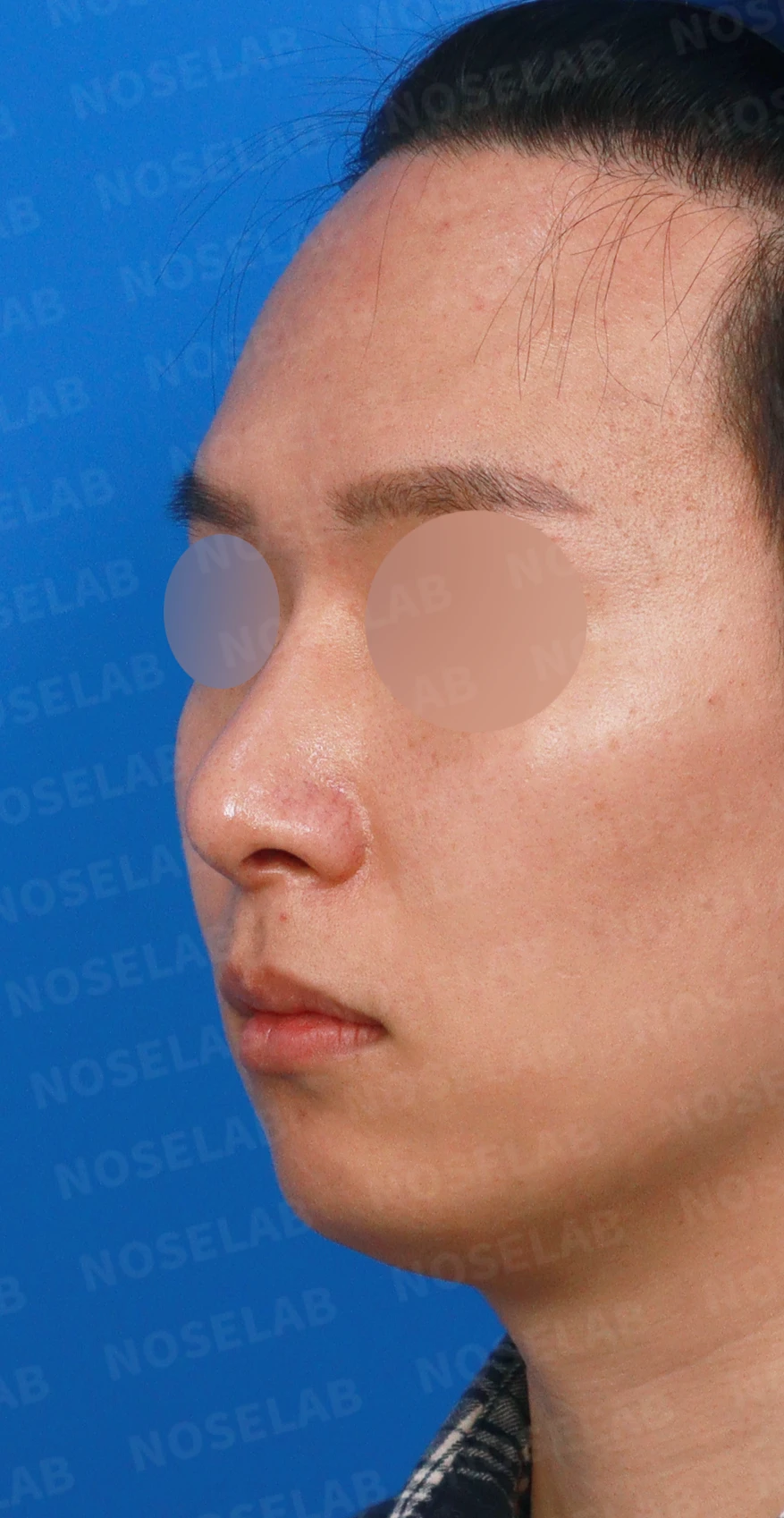 한쪽 비골이 함몰되면 왜 코가 휘어 보이는가, 절골 복원과 비중격 재건 — 디자인 상담 정면, 좌측 측면, 비스듬한 측면 사진