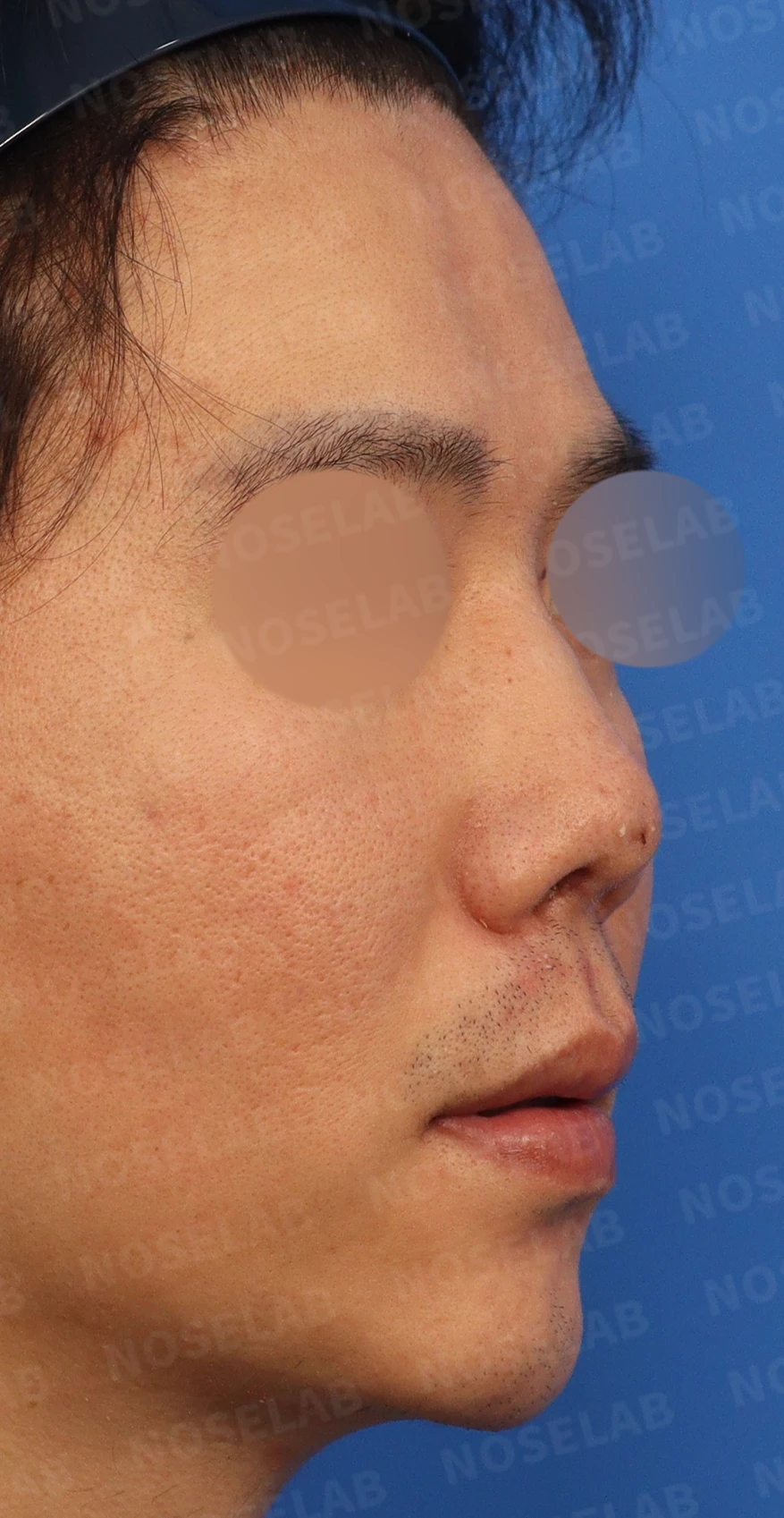 코끝 염증을 겪은 뒤 콧날개가 찝히고 코끝이 꺼지는 이유와 재건 방법 — 디자인 상담 우측 비스듬한 측면, 측면, 비공 사진