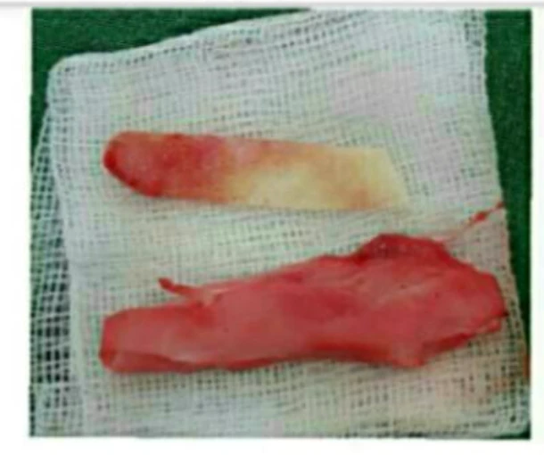 메드포어로 손상된 비중격, 자가늑연골로 완벽하게 재건하다 — 본문 사진 7