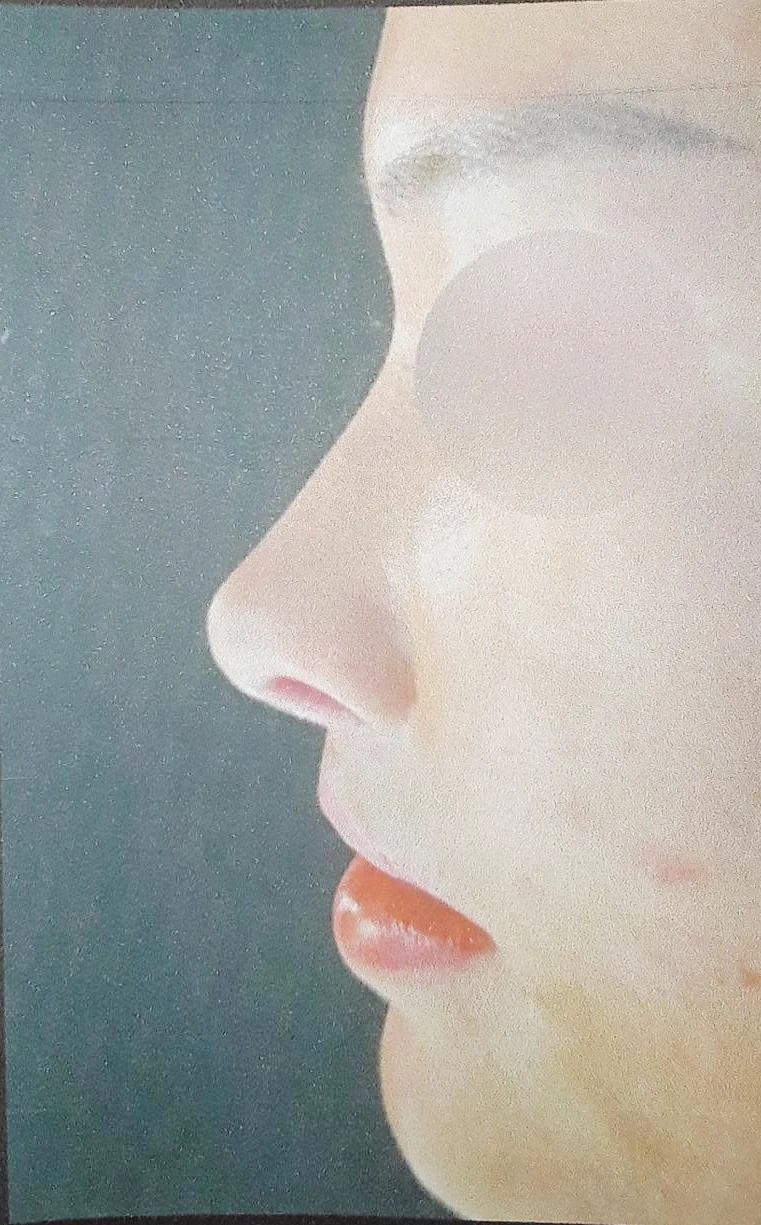 코끝 처짐과 코막힘을 함께 살펴보는 재수술 방법 — 환자분이 원하시는 사진들입니다.