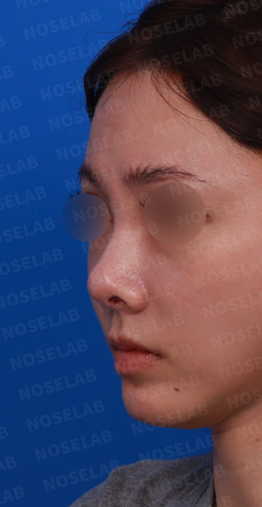 필러와 실 시술을 반복한 코에 미간이 퍼지고 코끝이 들리는 이유 — 디자인 상담 정면 , 좌측 , 비스듬한 측면 , 측면 사진입니다.