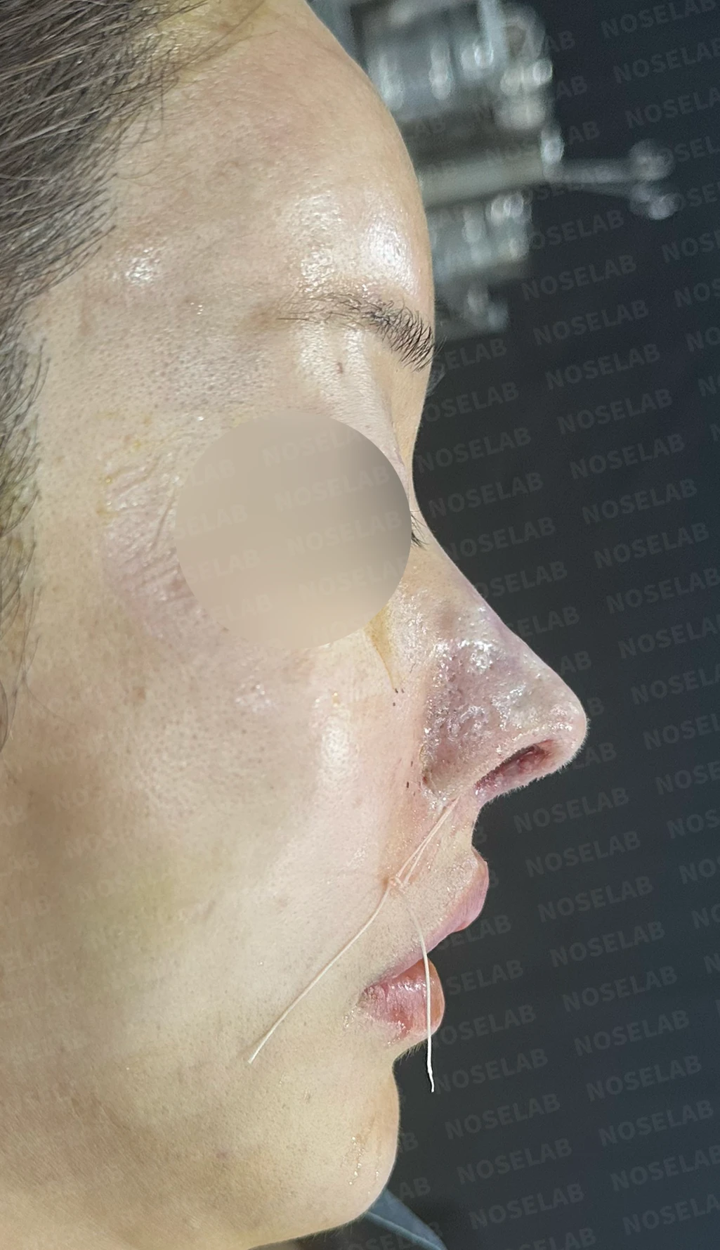 코 수술 뒤 콧등 피부가 괴사하면 어떤 변화가 남고, 재건은 어떻게 하나 — 수술 전 / 수술 직후 0일 직후 사진은 부기가 있는 상태로 최종 결과와 다를 수 있습니다.