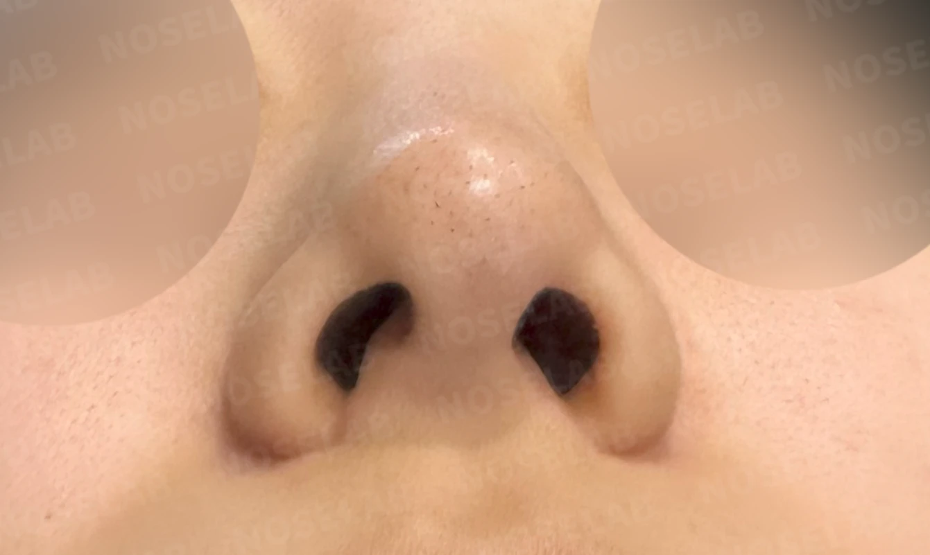 매부리를 정리한 뒤 콧등이 눌려 보이고 코끝이 뭉툭해지는 이유, 보형물 없이 교정하는 방법 — 수술 전 / 수술 직후 0일 직후 사진은 부기가 있는 상태로 최종 결과와 다를 수 있습니다.
