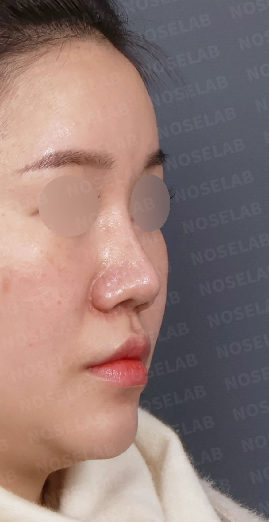 비주 함몰과 콧날개 변형, 자가늑연골을 이용한 코재수술로 자연스럽게 교정 — 디자인 상담 우측 측면, 비스듬한 측면, 비공 사진입니다.