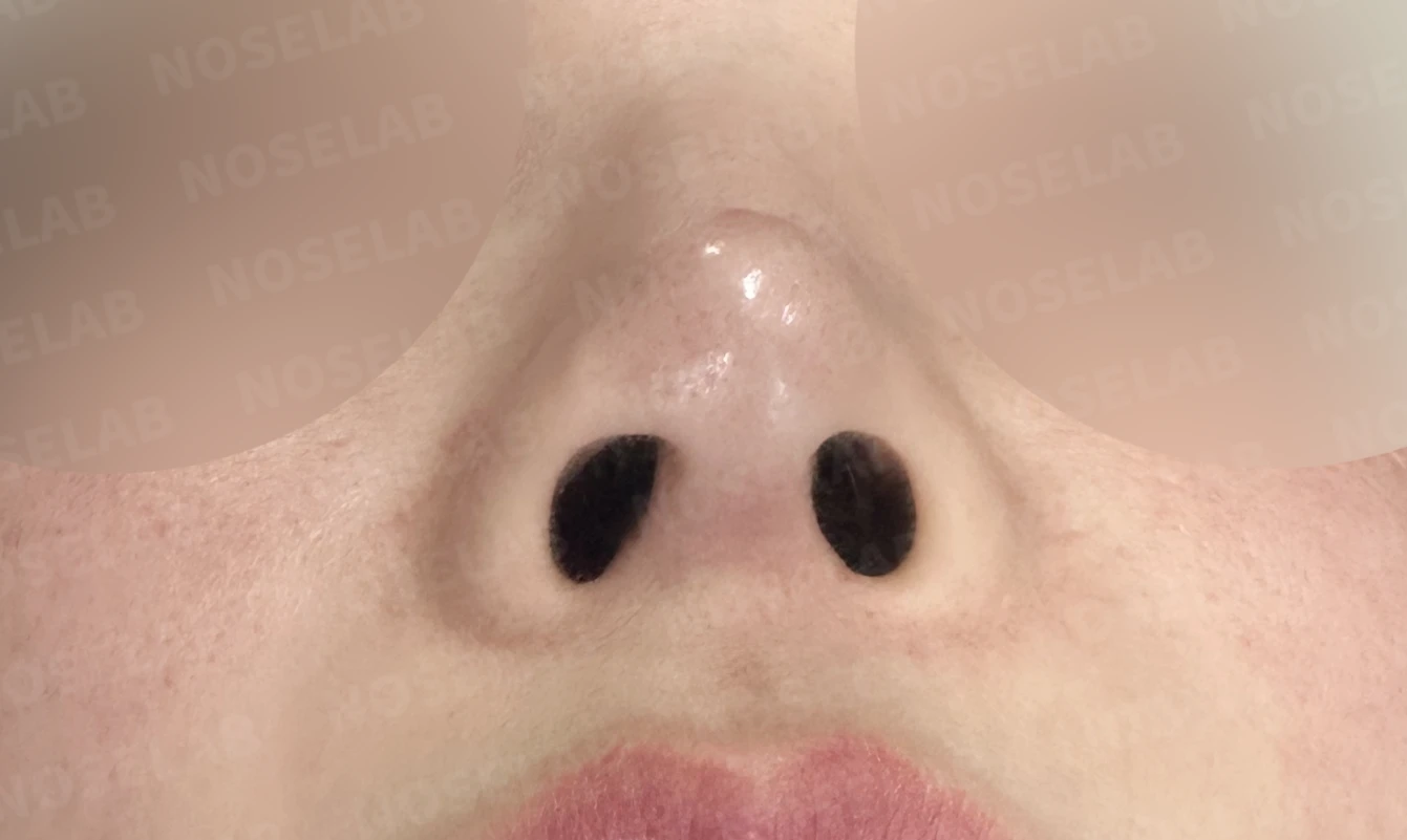 여러 차례 코수술 후 자가늑연골과 자가진피로 코 전체를 자연스럽게 높인 재수술 — 전(좌) 직후(후)
