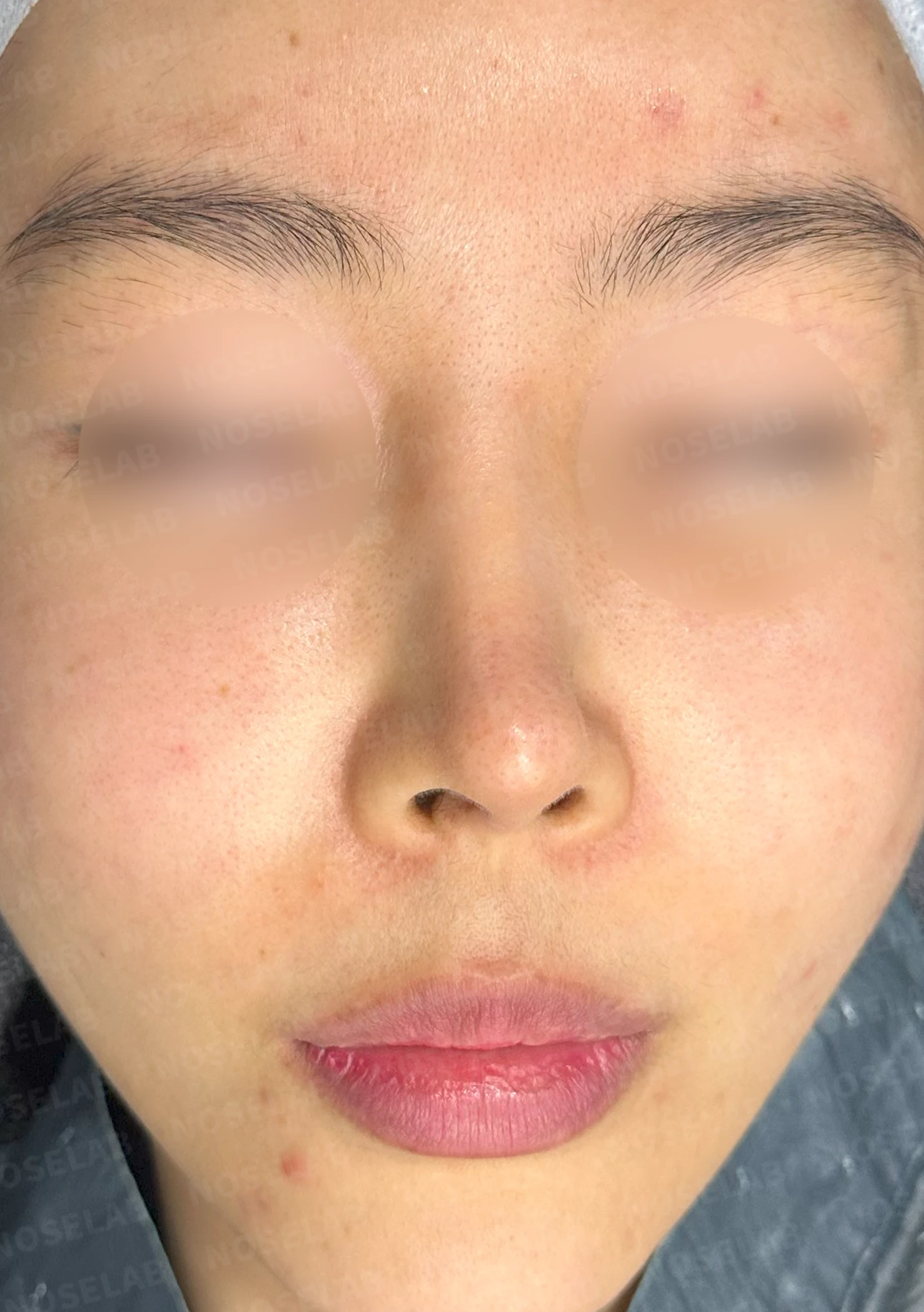 코가 들리고 콧기둥이 꺼지며 코끝이 찝혀 보이는 이유, 복합 교정은 어떻게 하나 — 수술 전 / 수술 직후 0일 직후 사진은 부기가 있는 상태로 최종 결과와 다를 수 있습니다.