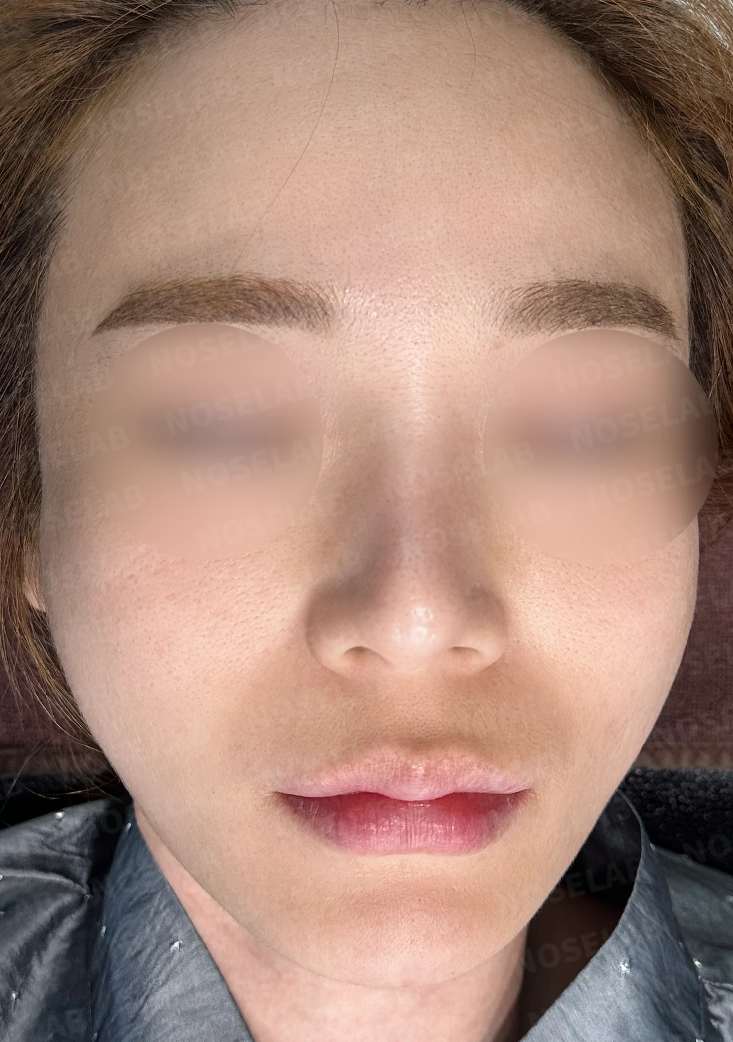비익과 비공 비대칭의 재수술 방법 — 수술 전 / 수술 직후 0일 직후 사진은 부기가 있는 상태로 최종 결과와 다를 수 있습니다.