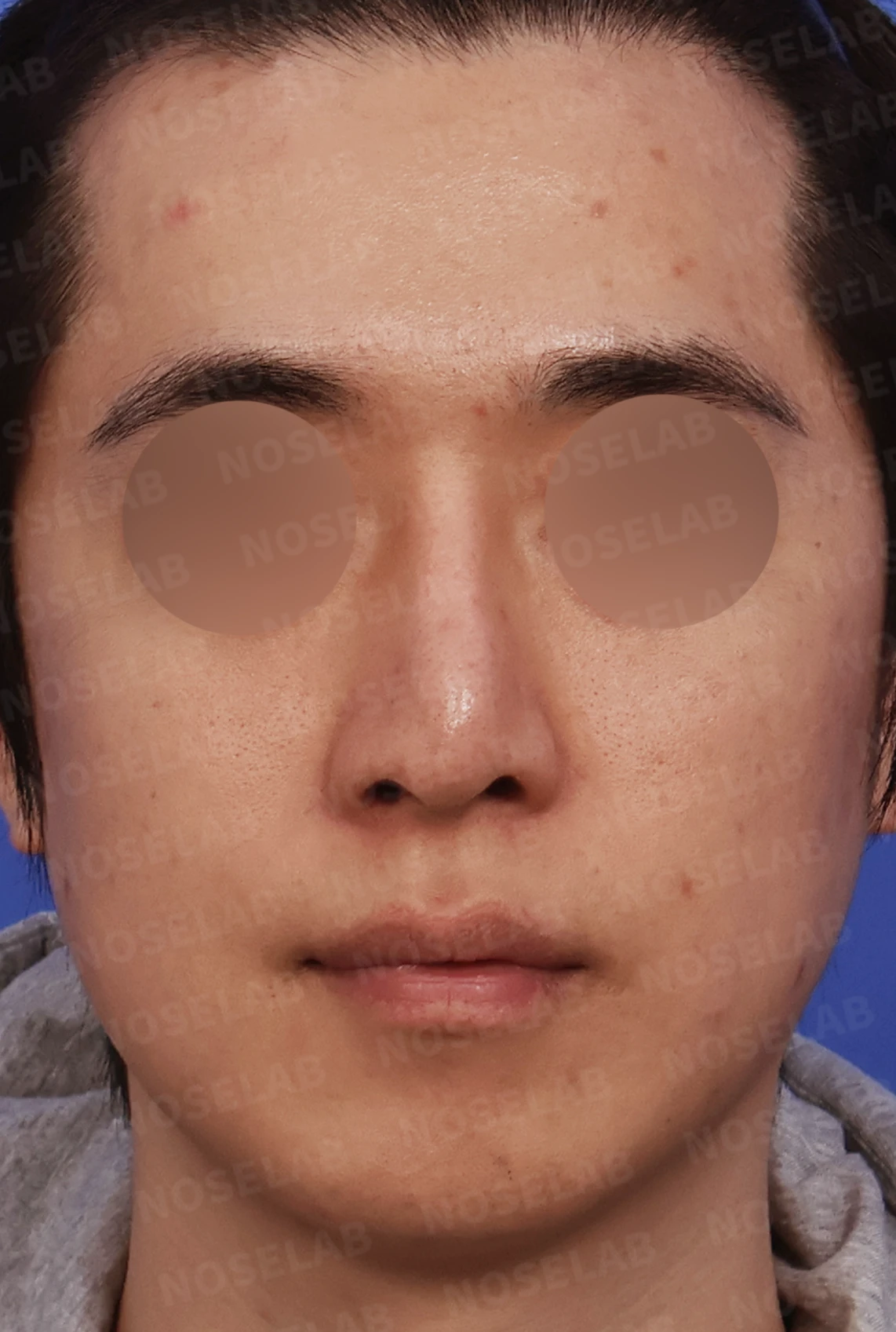 비중격이 한쪽으로 무너지면 왜 코막힘이 심해지는가 — 디자인 상담 정면, 좌측 측면, 비스듬한 측면 사진입니다.