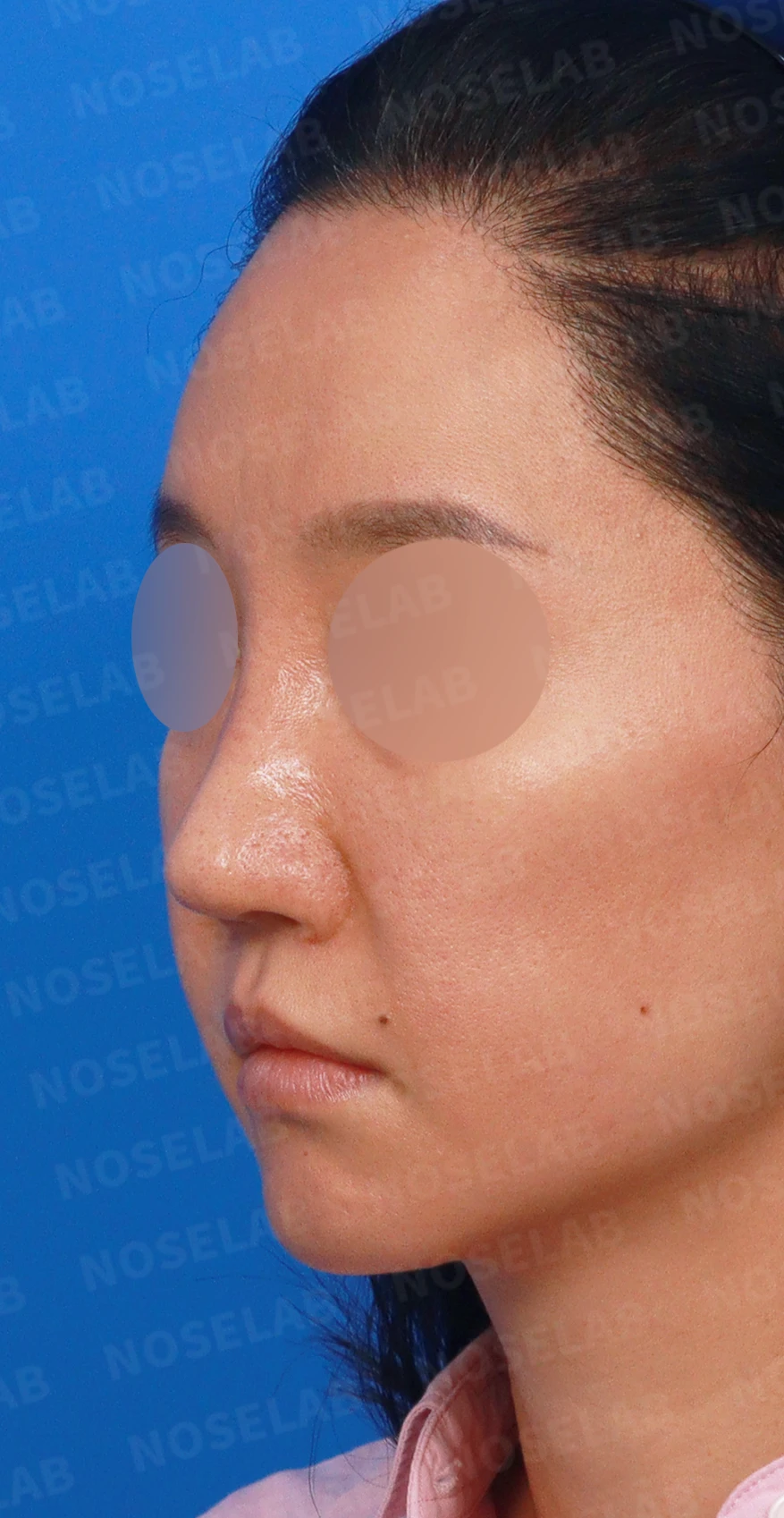 여러 번의 코재수술 뒤 비중격이 무너지는 이유, 자가늑연골 전면 재건은 어떻게 하나 — 디자인 상담 정면, 좌측 측면, 비스듬한 측면 사진입니다.