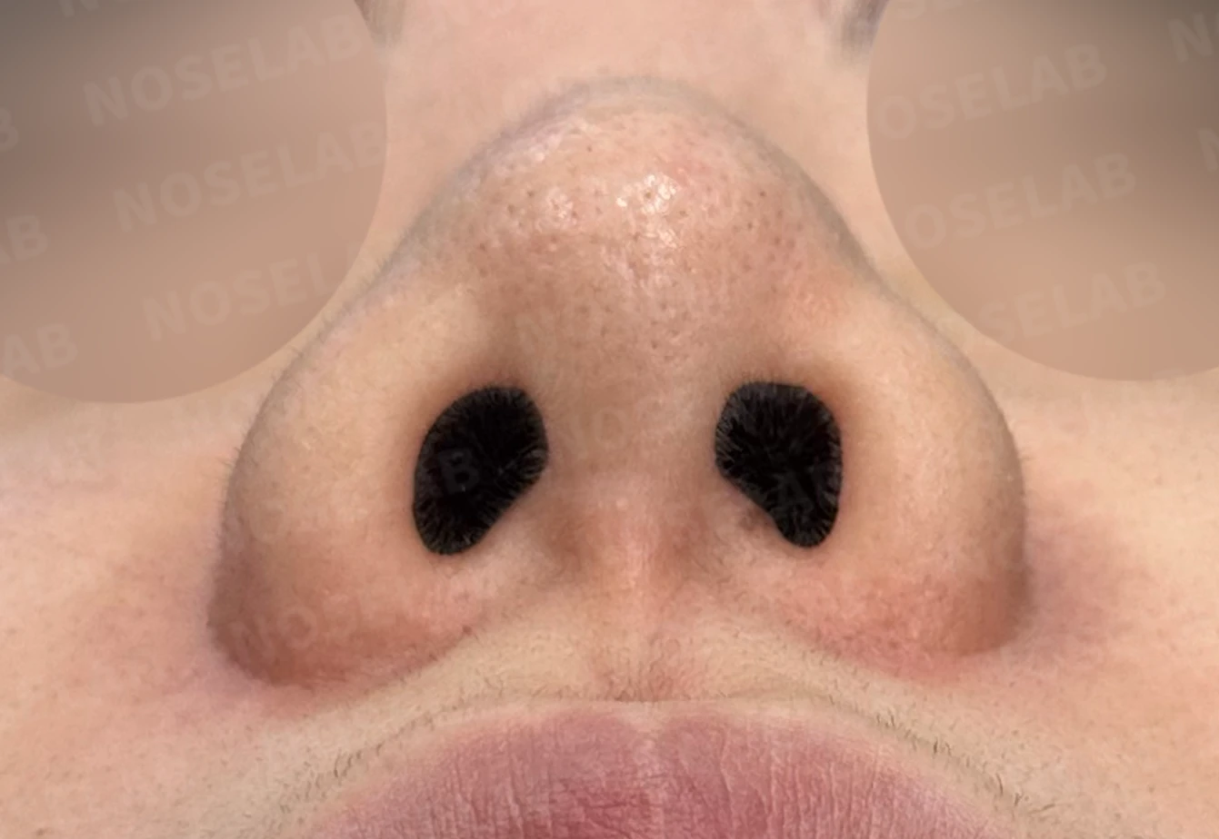 복코 교정과 비주 내리기 방법 — 수술 전 / 수술 직후 0일 직후 사진은 부기가 있는 상태로 최종 결과와 다를 수 있습니다.