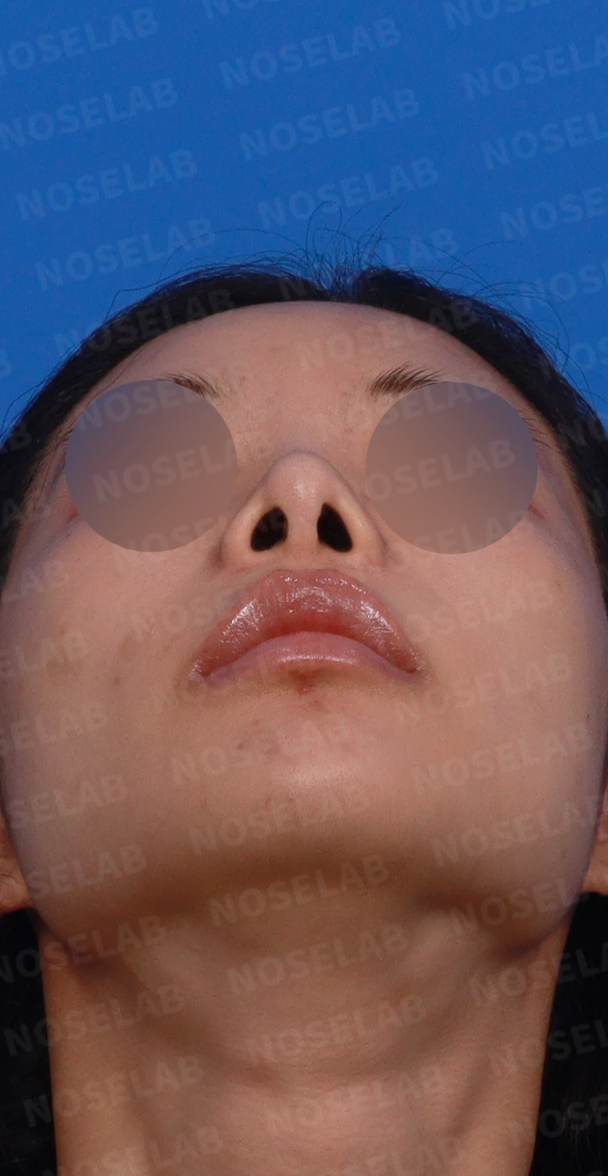 콧대 반영구 필러가 남기는 변화와 제거 후 비중격 재건 — 디자인 상담 우측 측면, 비스듬한 측면, 비공 사진입니다.