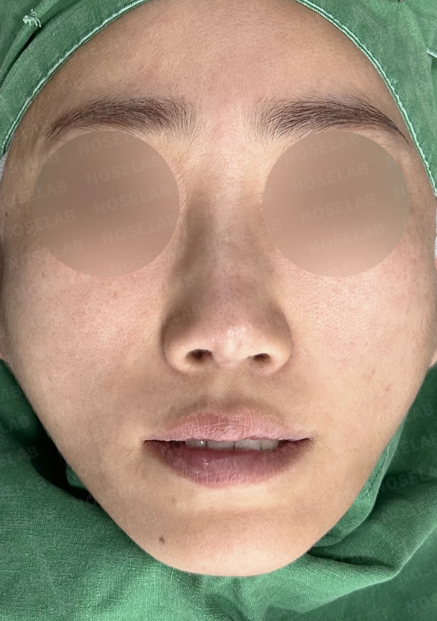 콧대에 주입한 불법 시술 이물질, 제거와 비중격 전체 재건은 어떻게 하나 — 수술 전 / 수술 직후 0일 직후 사진은 부기가 있는 상태로 최종 결과와 다를 수 있습니다.