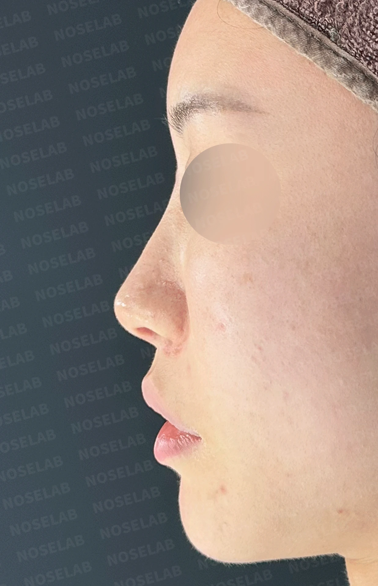이전 수술로도 달라지지 않는 뭉툭한 코끝, 원인과 재건 방법 — 본문 사진 9
