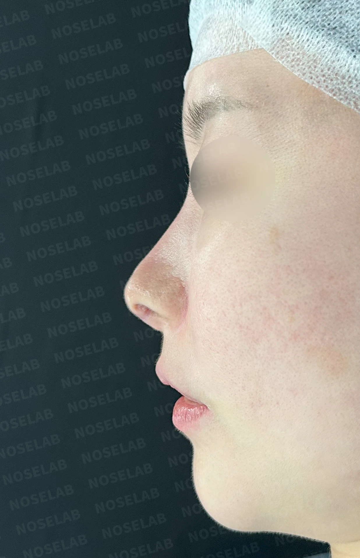 코성형 후 남는 미세한 높이 부족과 좌우 비대칭, 왜 생기고 어떻게 보강하나 — 수술 전 / 수술 직후 0일 직후 사진은 부기가 있는 상태로 최종 결과와 다를 수 있습니다.