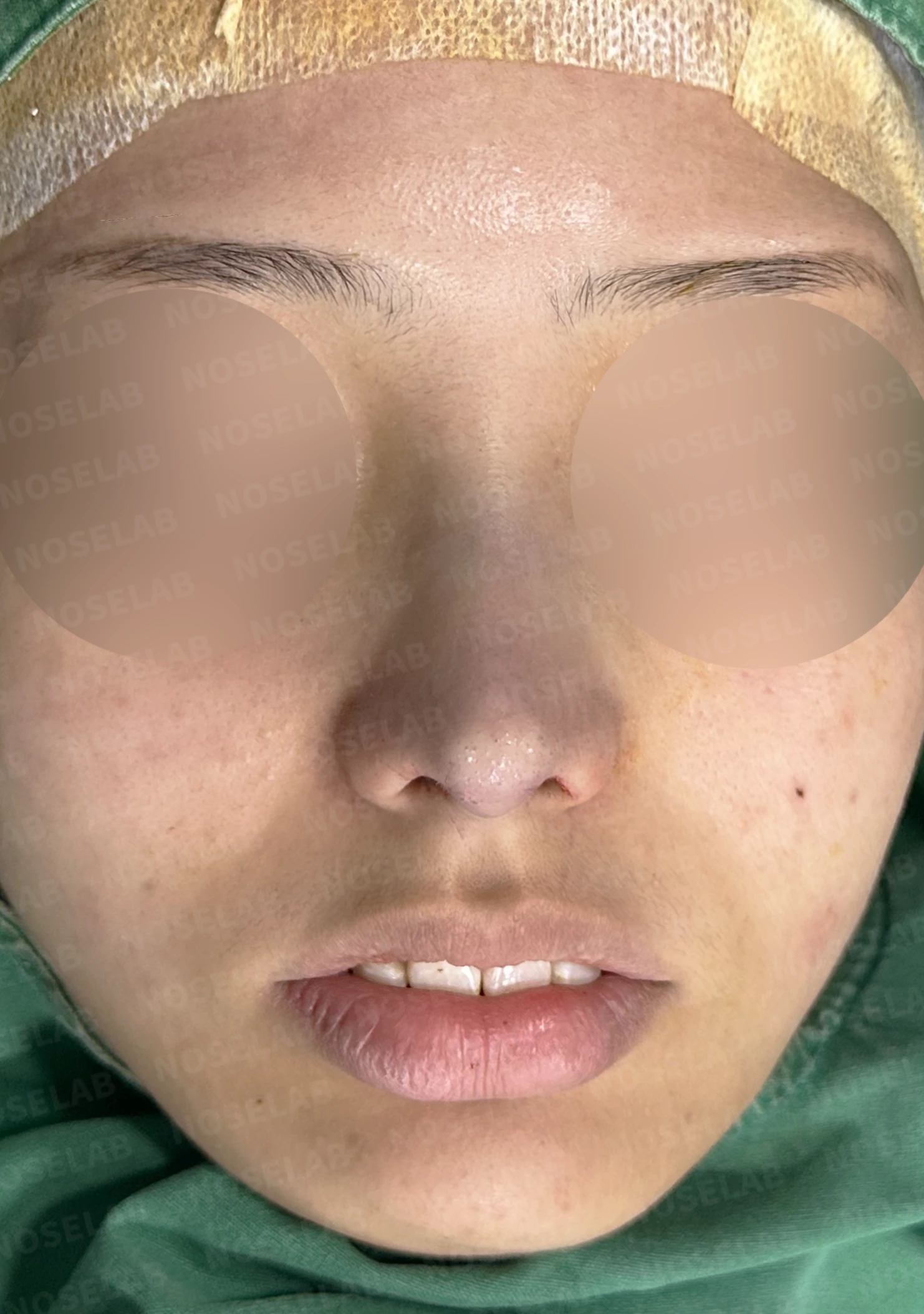 휘어진 매부리와 처진 코끝이 생기는 이유, 비중격 연장술은 어떻게 하나 — 수술 전 / 수술 직후 0일 직후 사진은 부기가 있는 상태로 최종 결과와 다를 수 있습니다.