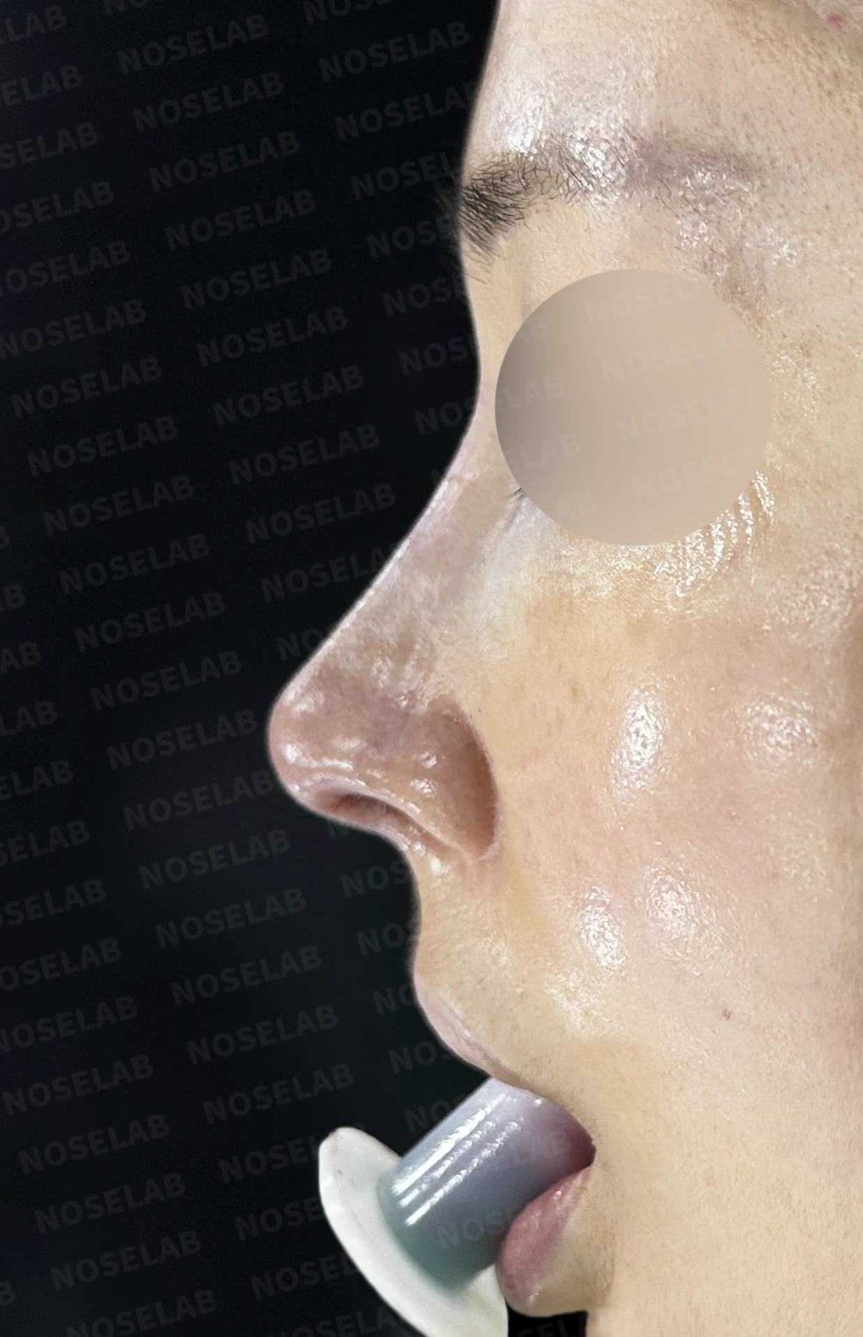 보형물 비침과 용코, 자가늑연골로 안전하게 교정한 코재수술 — 수술직후 정면, 비스듬한 측면, 측면 사진입니다.