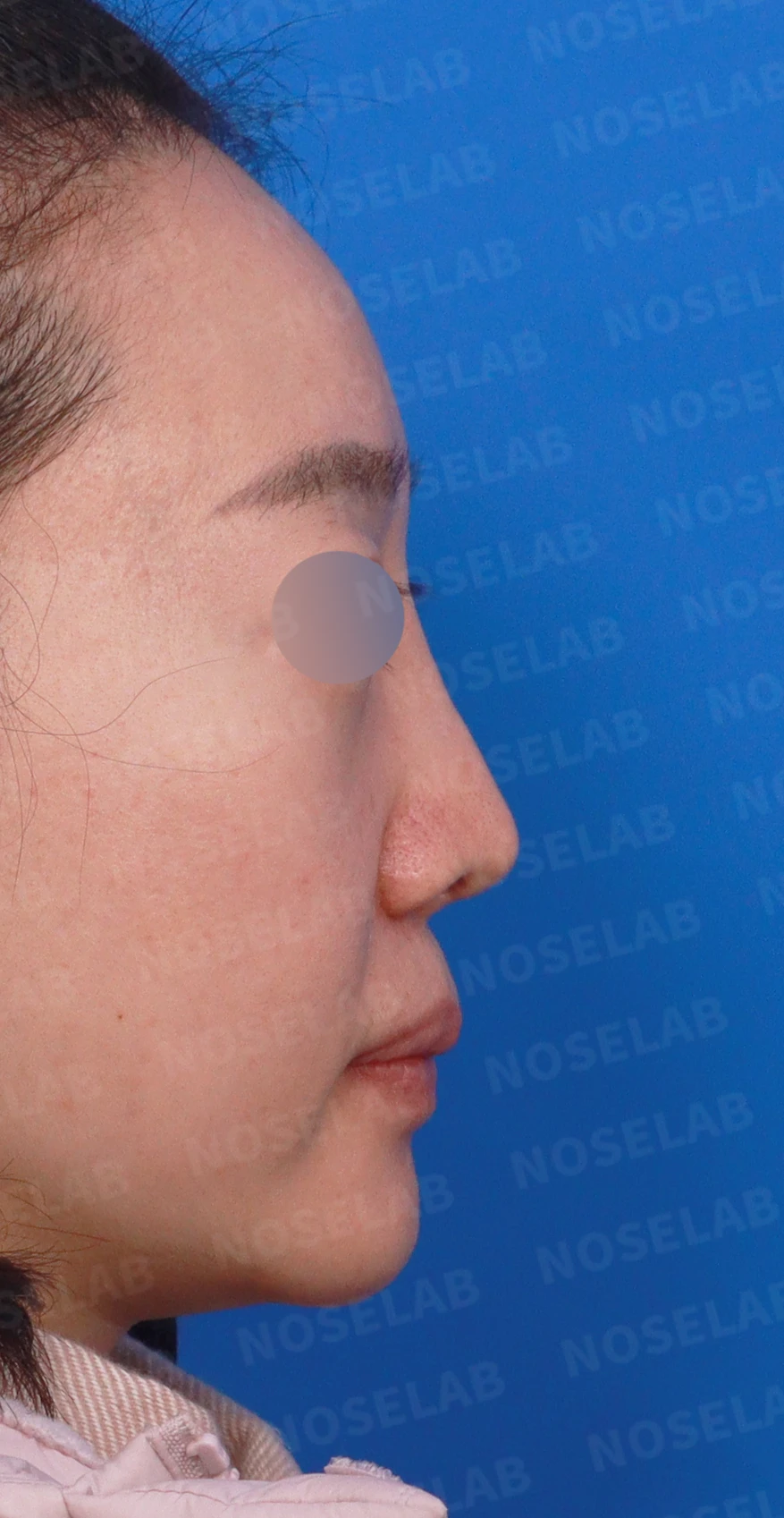 비중격이 한쪽으로 무너지면 코가 휘고 숨이 막히는 이유, 자가늑연골 재건 방법 — 디자인 상담 우측 측면, 비스듬한 측면, 비공 사진입니다.