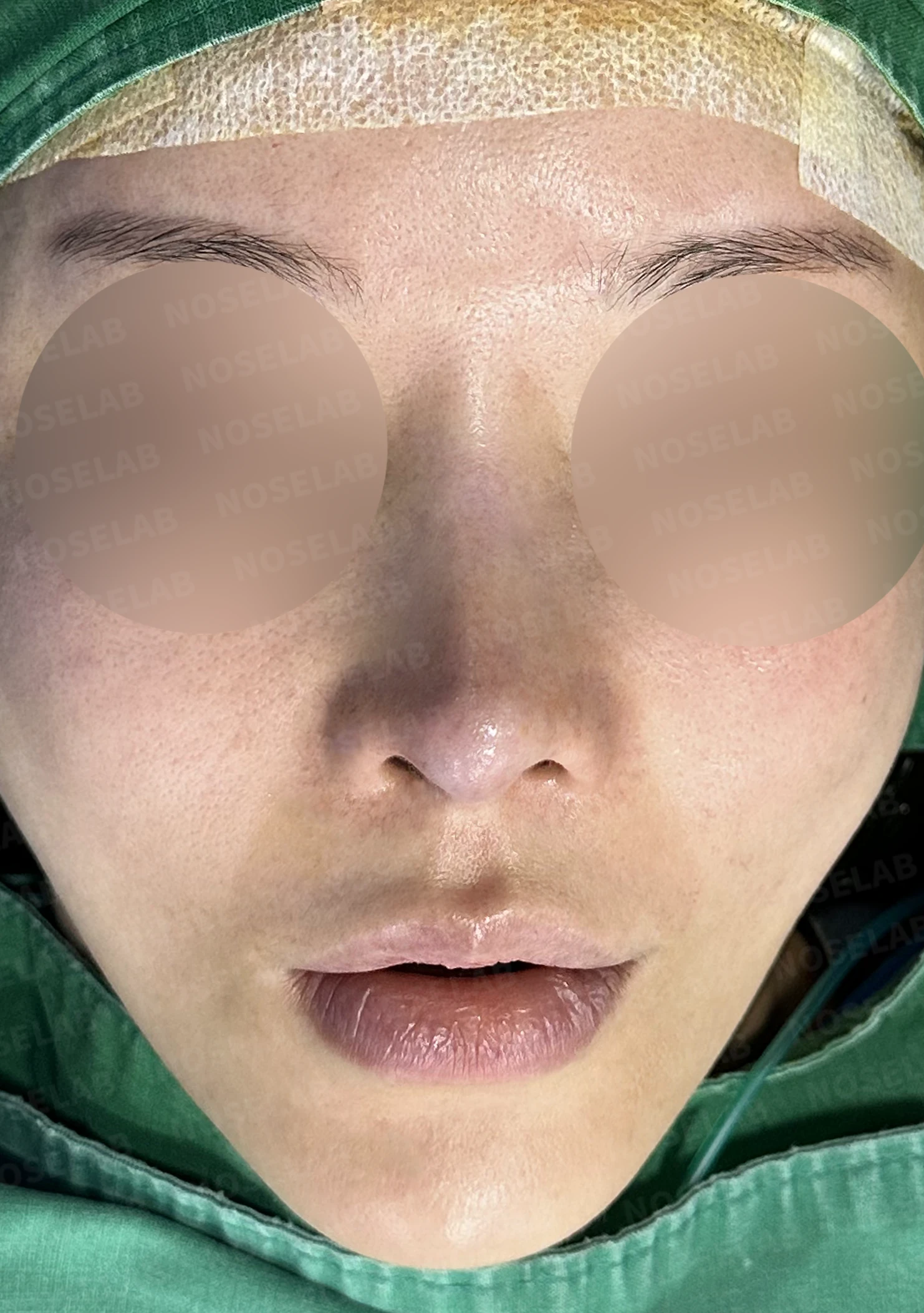 비중격 완전 재건으로 오똑한 코끝과 비공 비대칭 교정 — 전(좌) , 직후(후)
