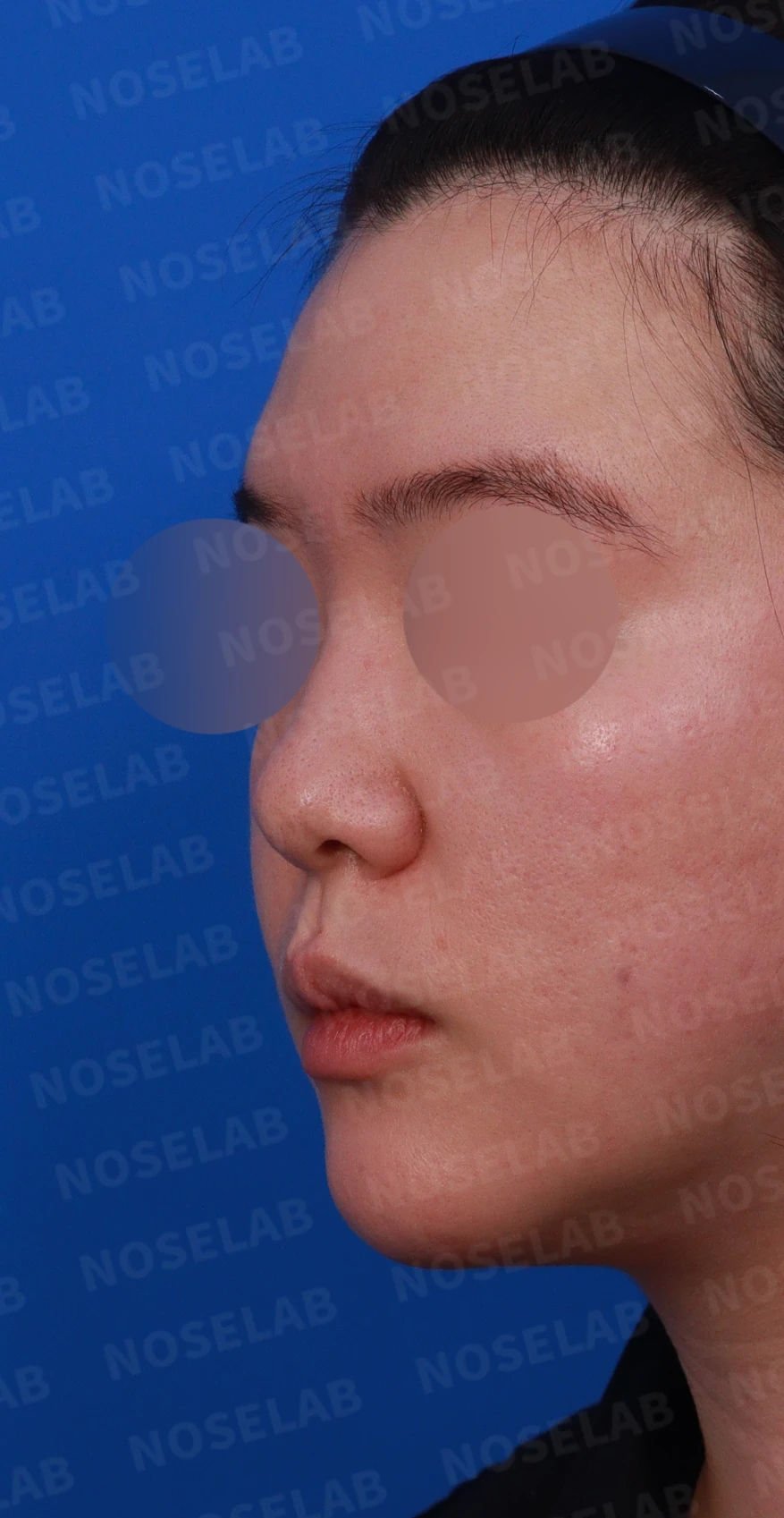 코끝이 퍼지고 입체감이 없어 보이는 이유, 복코 교정은 어떻게 하나 — 디자인 상담 정면, 좌측 측면, 비스듬한 측면 사진