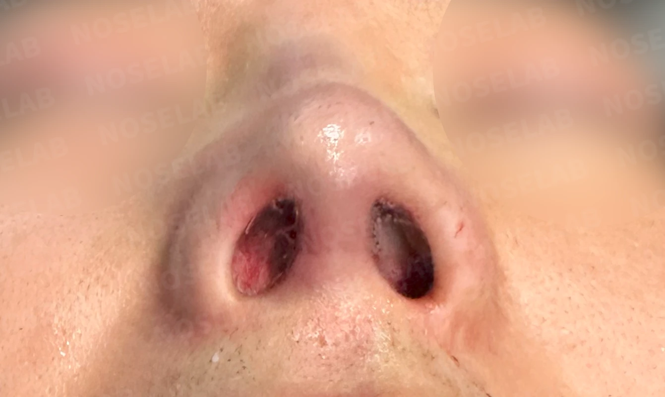 매부리코 수술 후 비대칭의 재수술 방법 — 수술 직후 0일 비공 사진 직후 사진은 부기가 있는 상태로 최종 결과와 다를 수 있습니다.