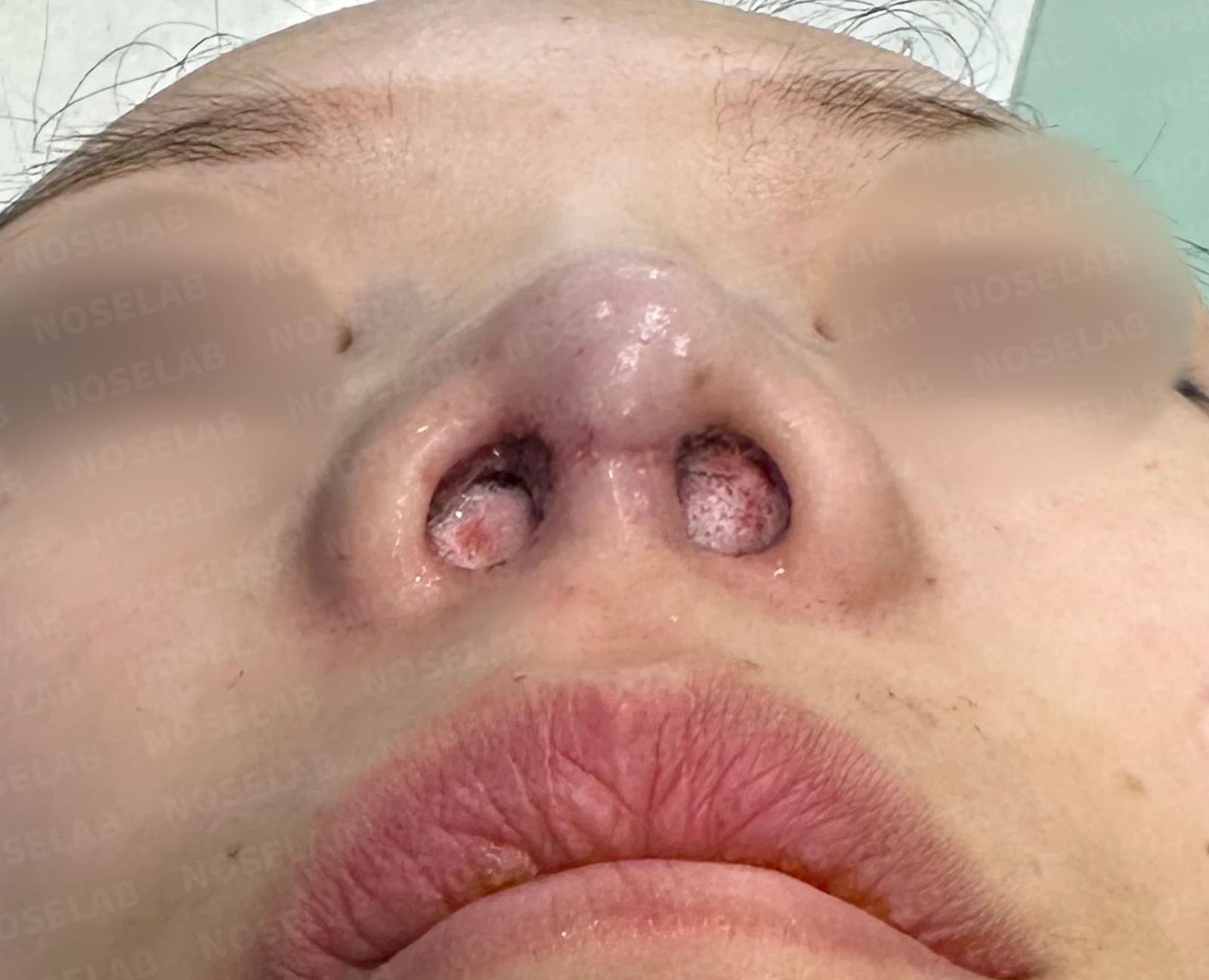 구축으로 함몰된 비주를 재건하는 방법 — 수술 전 / 수술 직후 0일 직후 사진은 부기가 있는 상태로 최종 결과와 다를 수 있습니다.