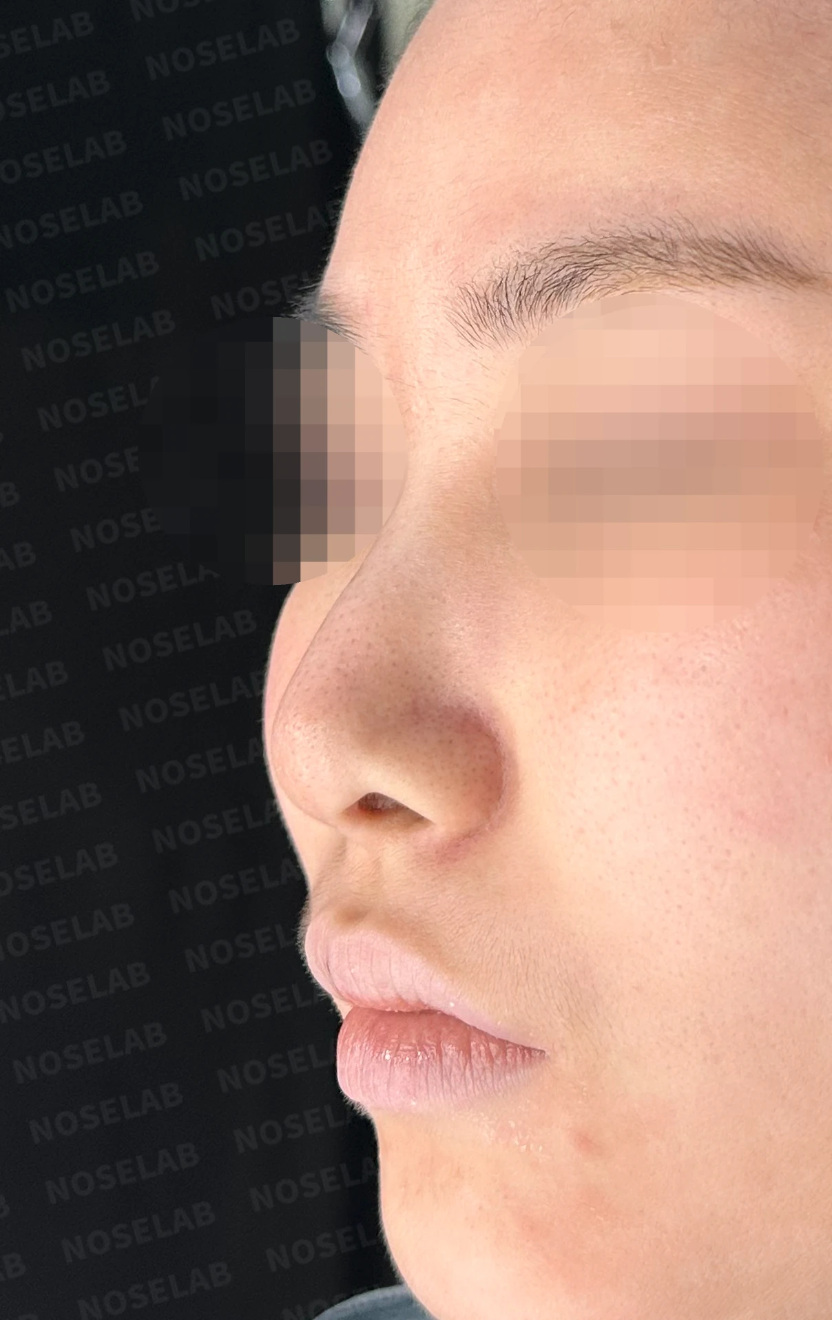 알레르기 체질에서 자가늑연골 무보형물 코성형을 계획할 때 — 수술 전 / 수술 직후 0일 직후 사진은 부기가 있는 상태로 최종 결과와 다를 수 있습니다.