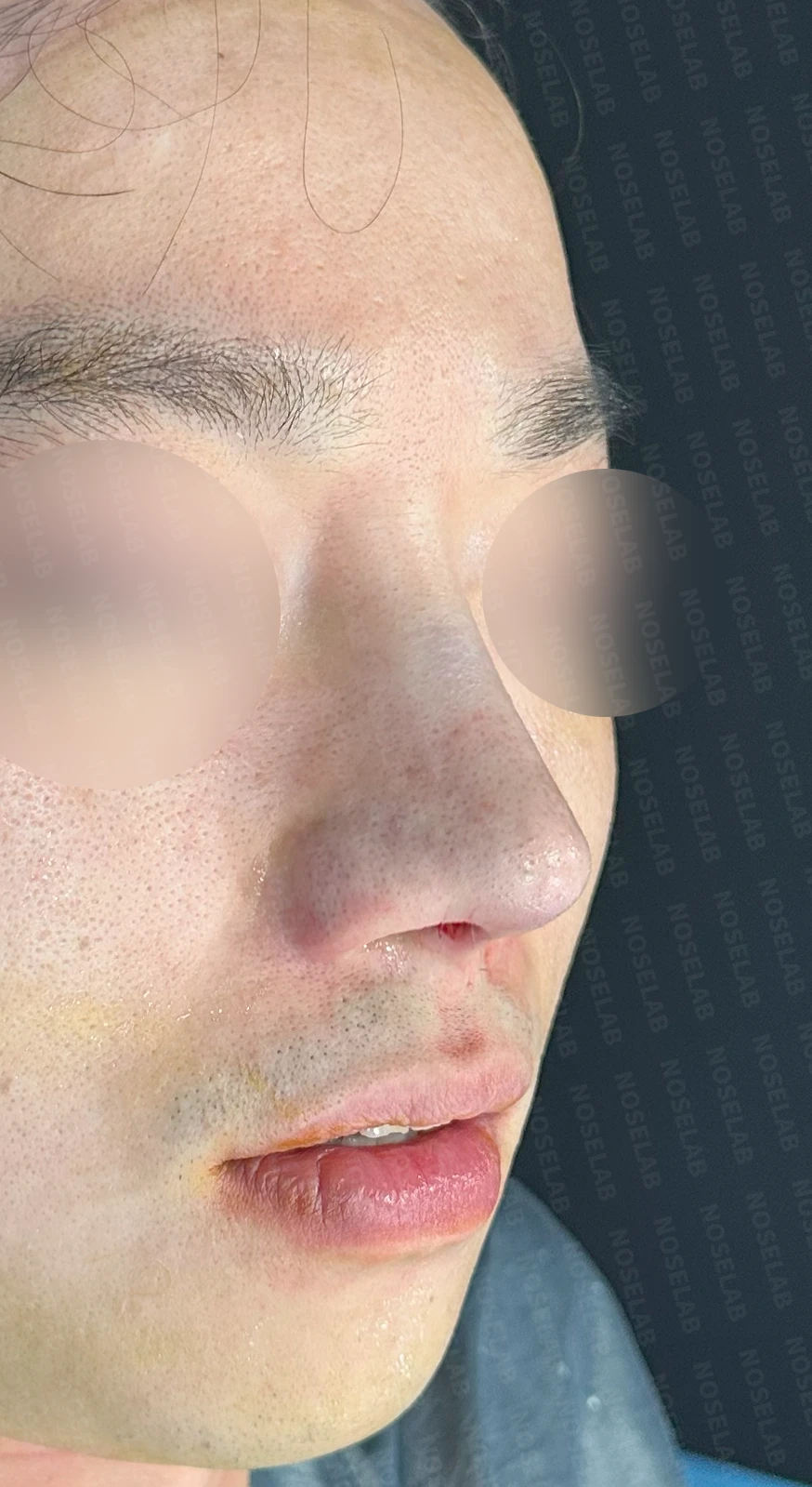 복코와 퍼진 코의 코성형 방법 — 수술 직후 0일 정면, 측면, 비스듬한 측면 사진입니다. 직후 사진은 부기가 있는 상태로 최종 결과와 다를 수 있습니다.