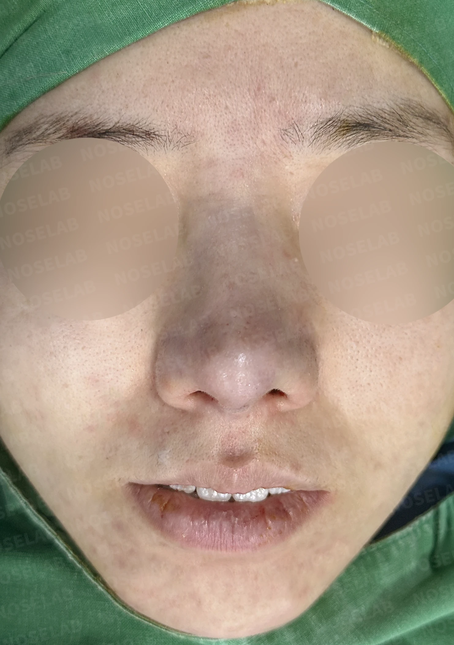 이전 수술 뒤 코가 딱딱해지고 짧아지는 구축, 왜 생기고 어떻게 재건하나 — 수술 직후 0일 정면, 비스듬한 측면, 측면 사진입니다. 직후 사진은 부기가 있는 상태로 최종 결과와 다를 수 있습니다.
