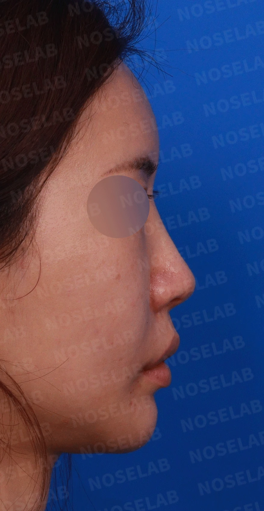 이전 수술로도 달라지지 않는 뭉툭한 코끝, 원인과 재건 방법 — 디자인 상담 우측 측면 , 비스듬한 측면 , 비공 사진입니다.